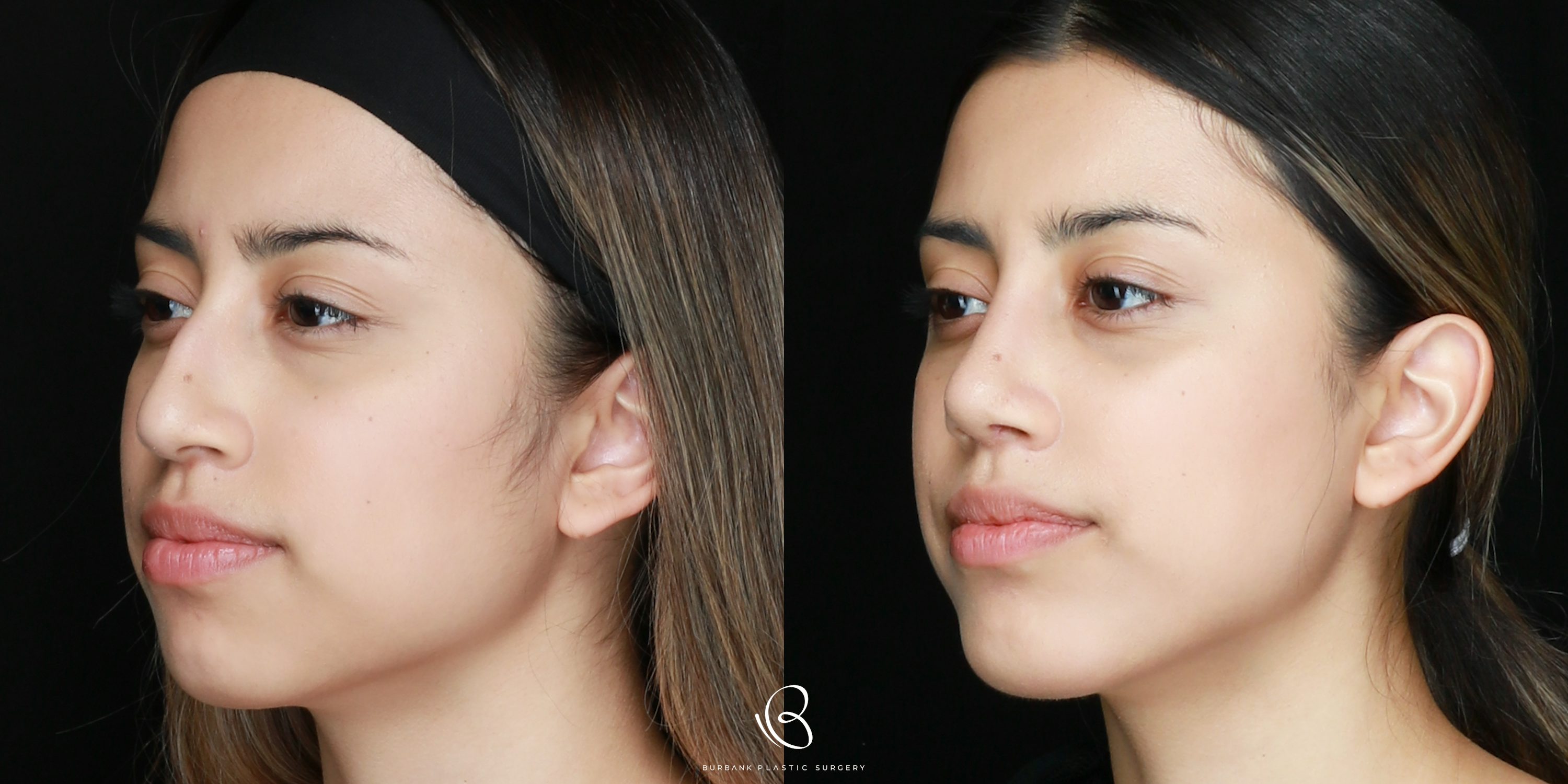 Woman Before and After Rhinoplasty Left Side 45 degree view