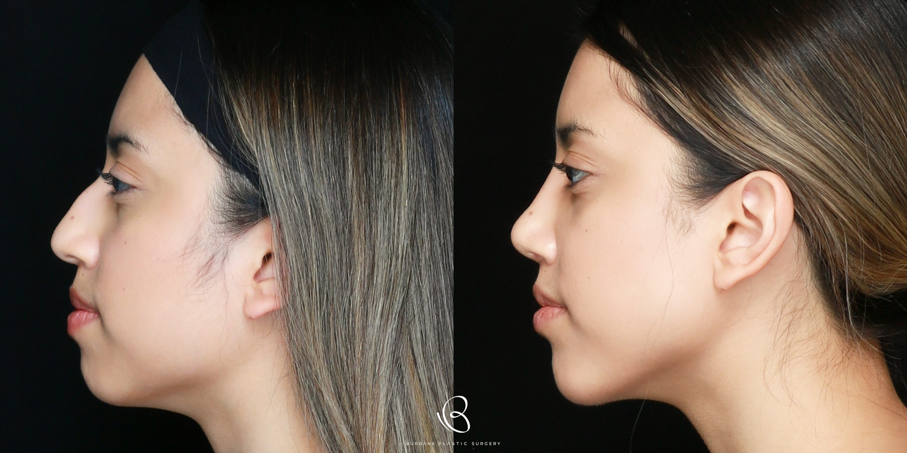Woman Before and After Rhinoplasty Left side View