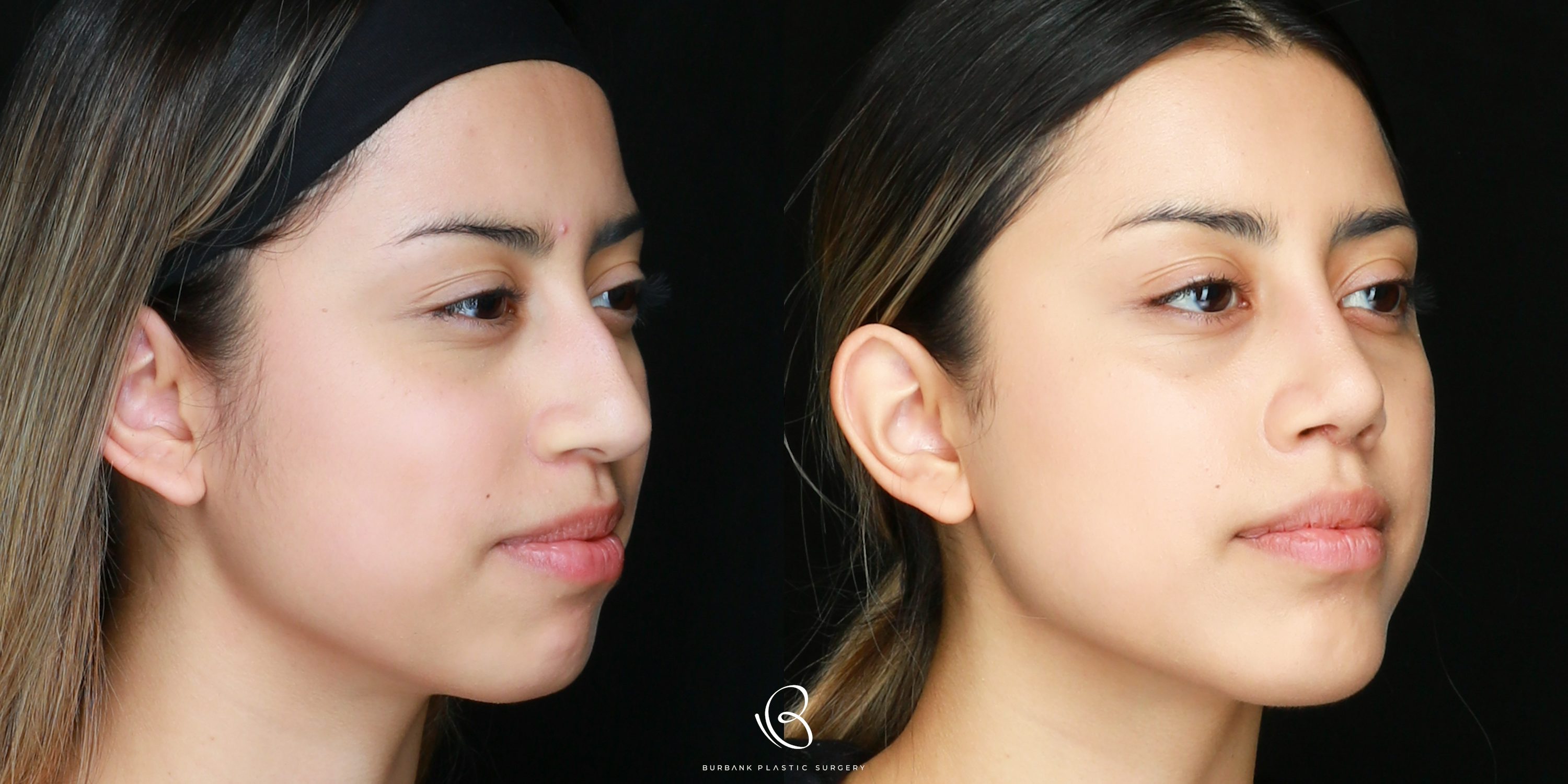 Woman Before and After Rhinoplasty Right side 45 degree View