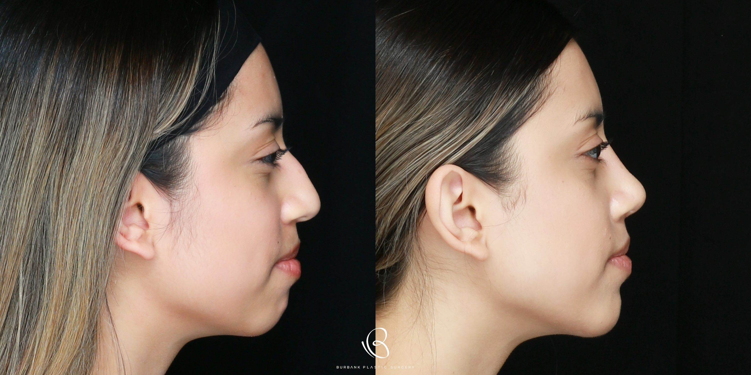 Woman Before and After Rhinoplasty Right side View