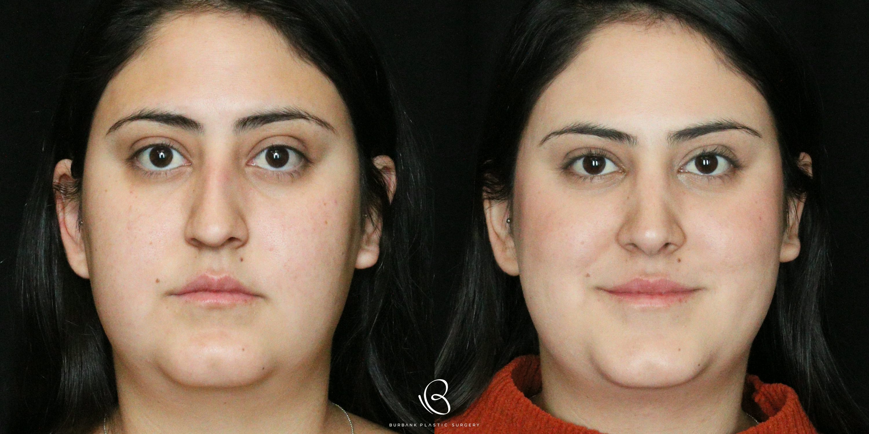Women Before and After Rhinoplasty Front