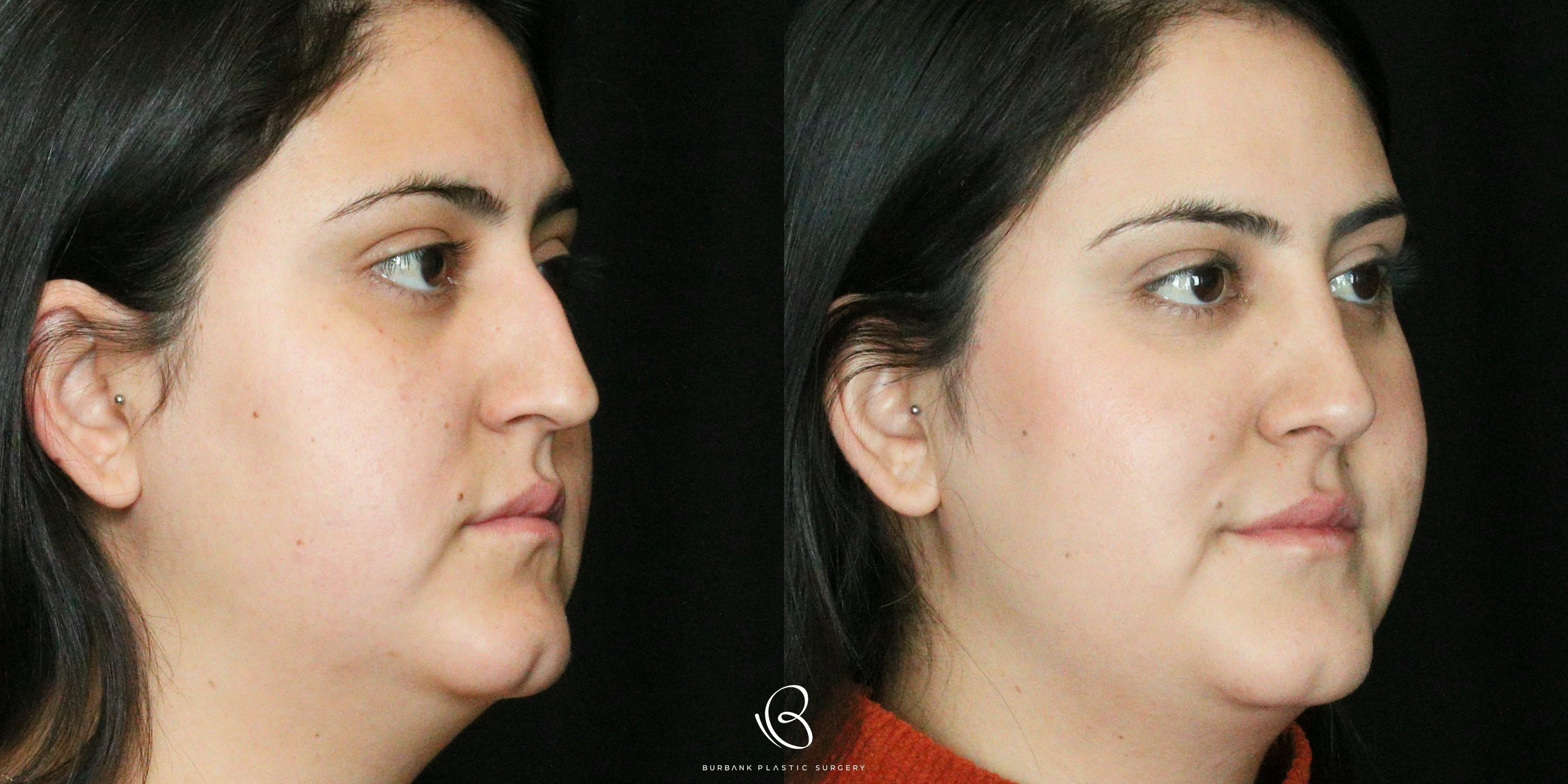 Women Before and After Rhinoplasty Right Side  45 degreeView
