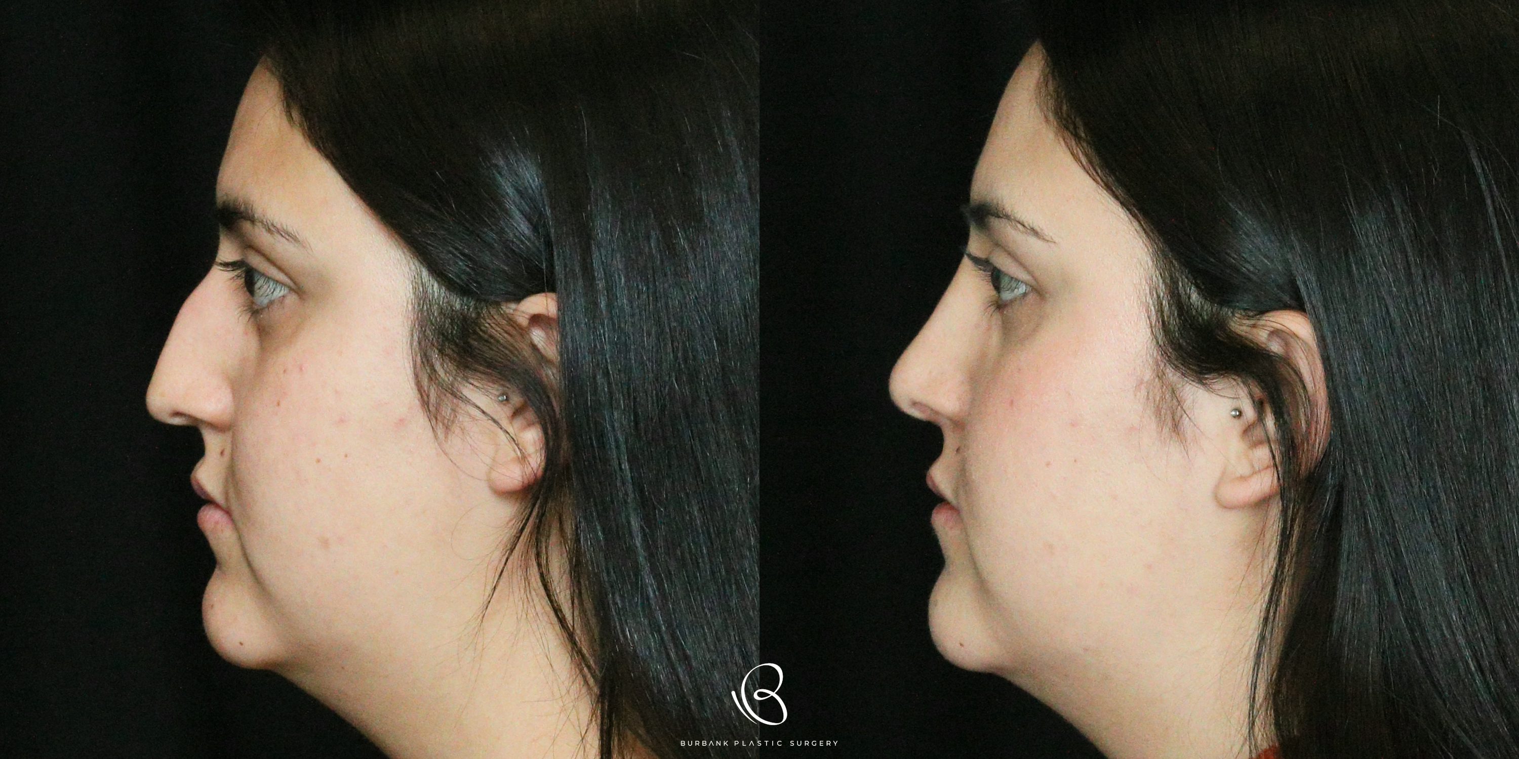 Women Before and After Rhinoplasty Left Side View