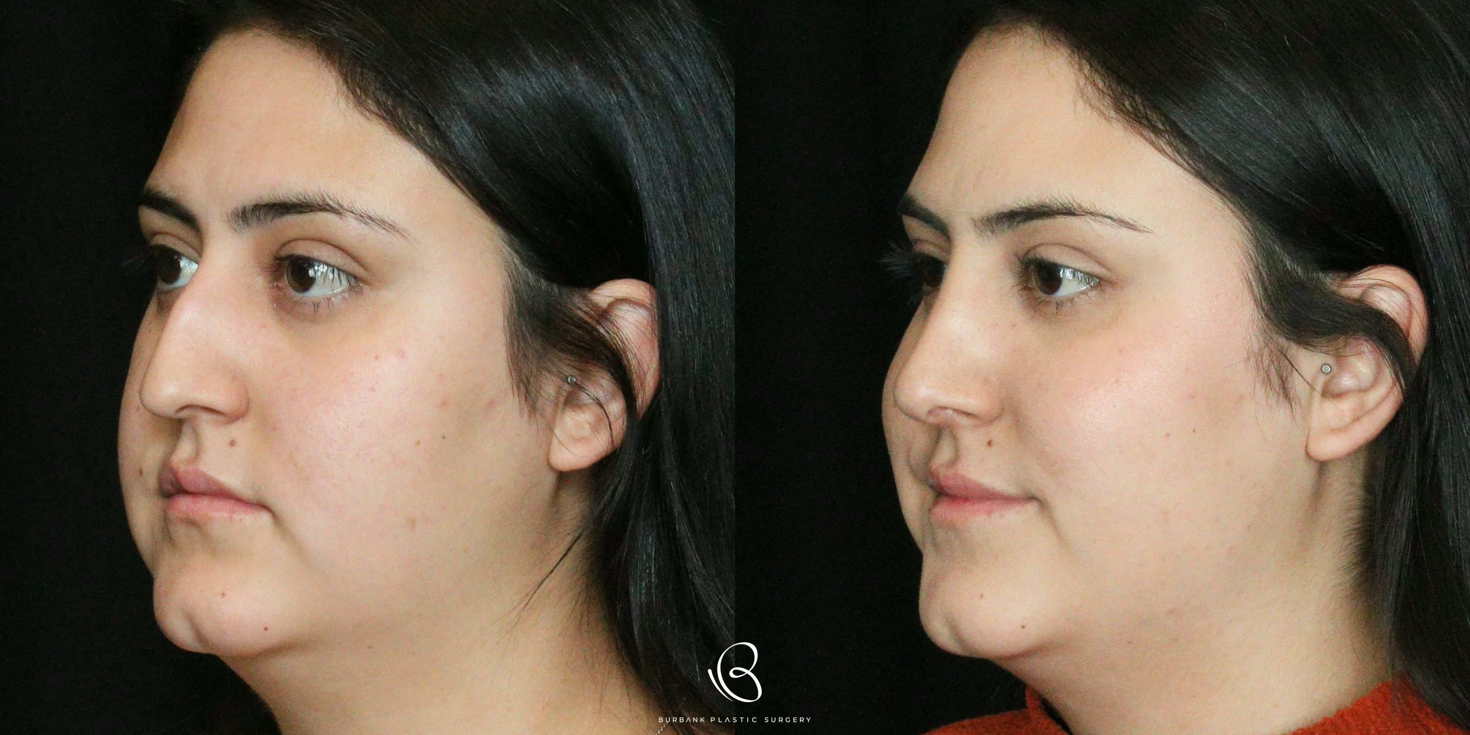 Women Before and After Rhinoplasty Left Side 45 degree View
