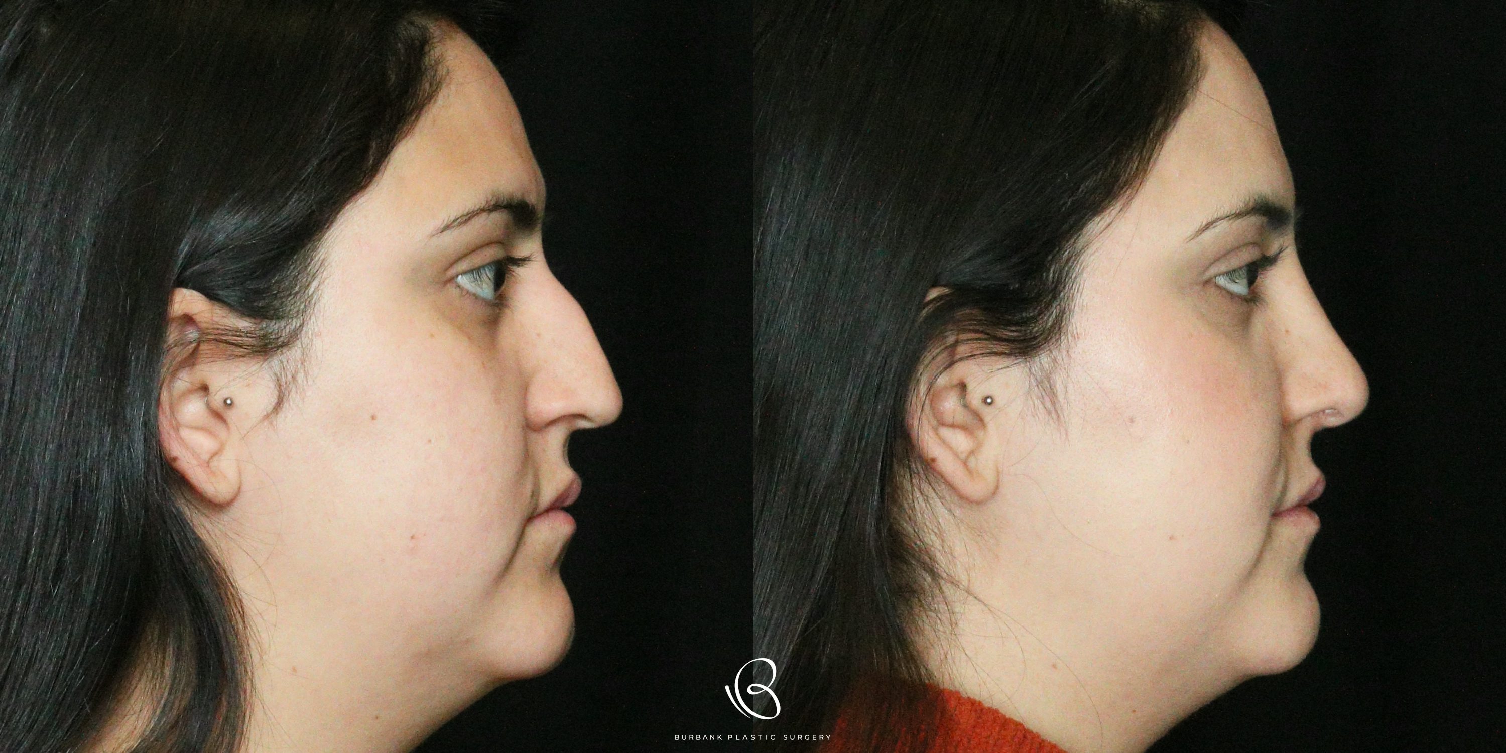 Women Before and After Rhinoplasty Right Side View