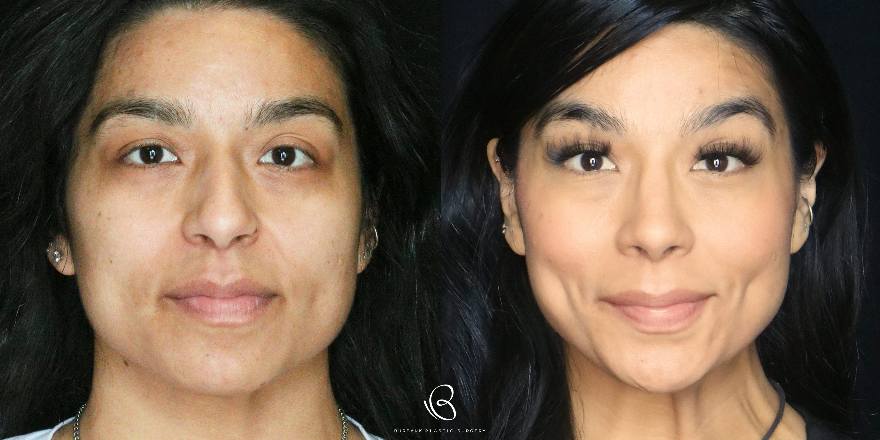 Women Before and After Rhinoplasty Front View