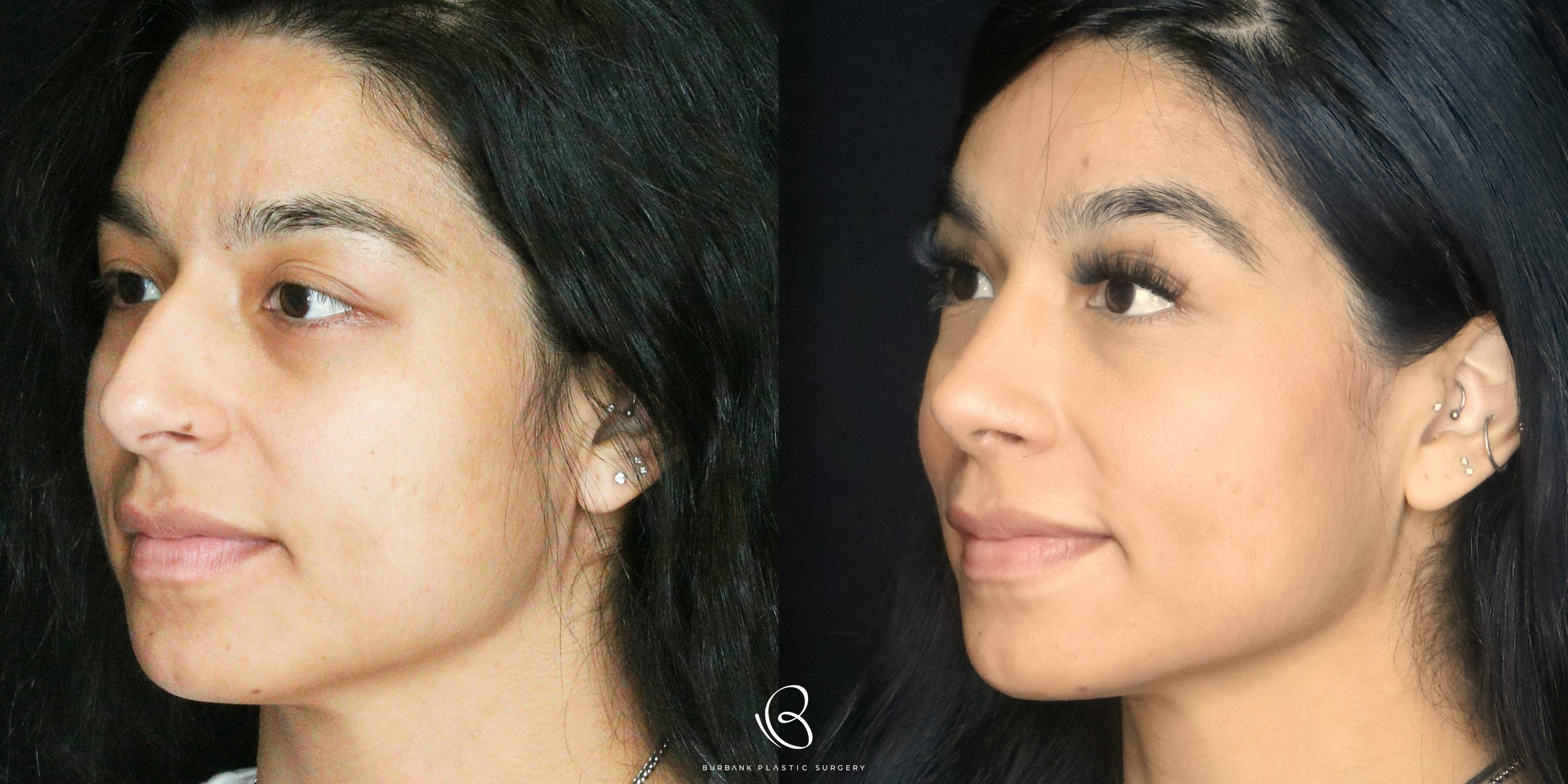 Women Before and After Rhinoplasty Left Side 45 Degree View