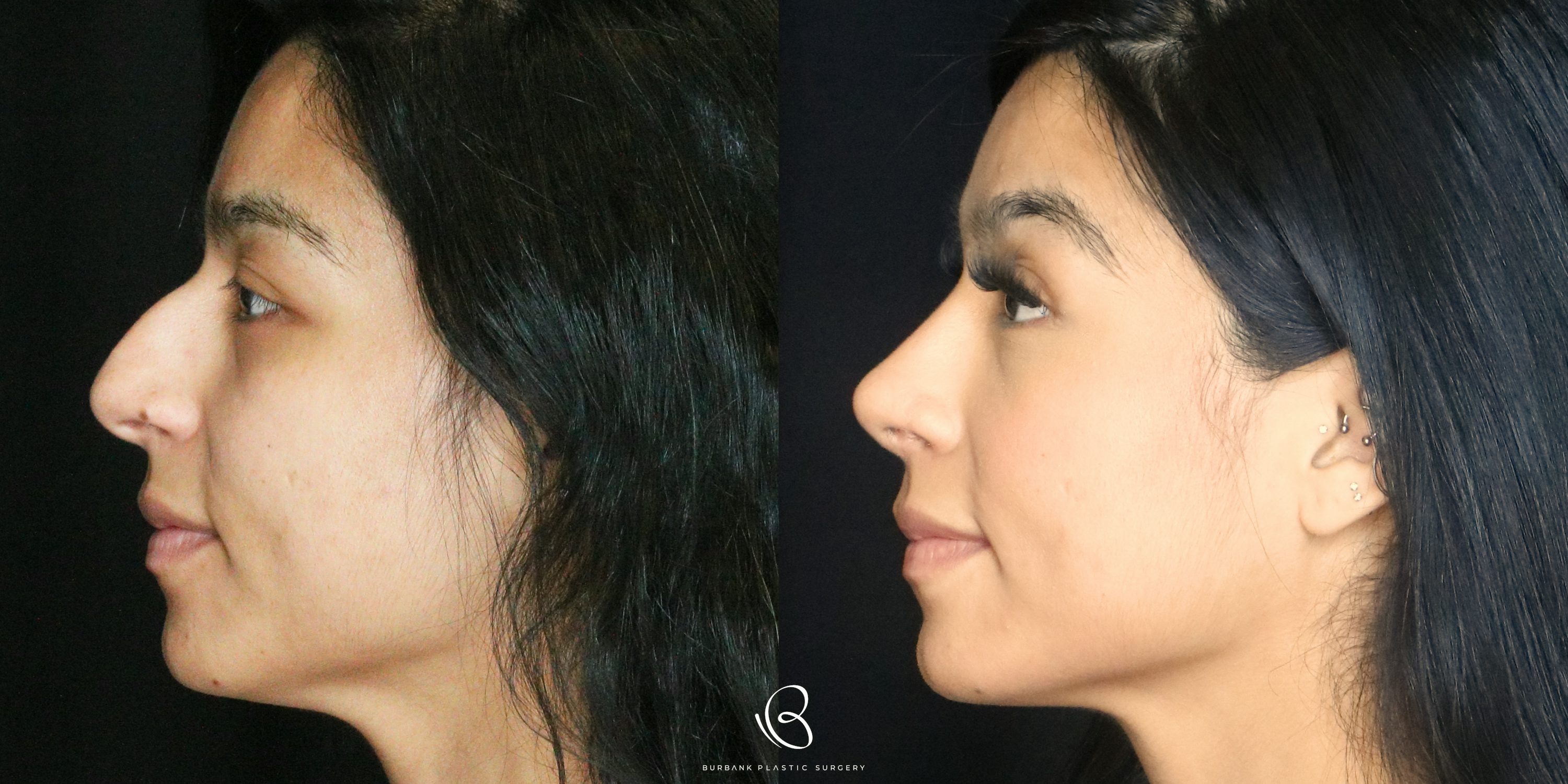 Women Before and After Rhinoplasty Left Side View