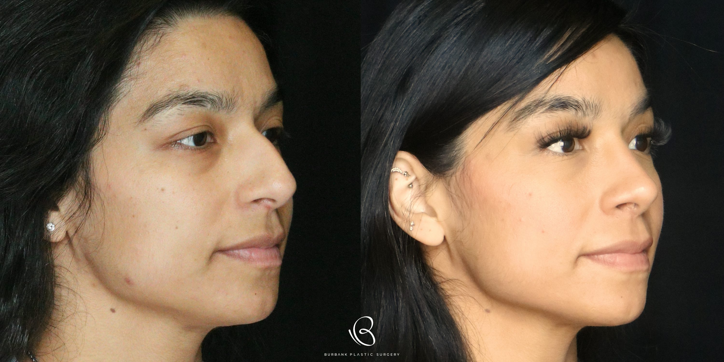Women Before and After Rhinoplasty Right Side 45 Degree View