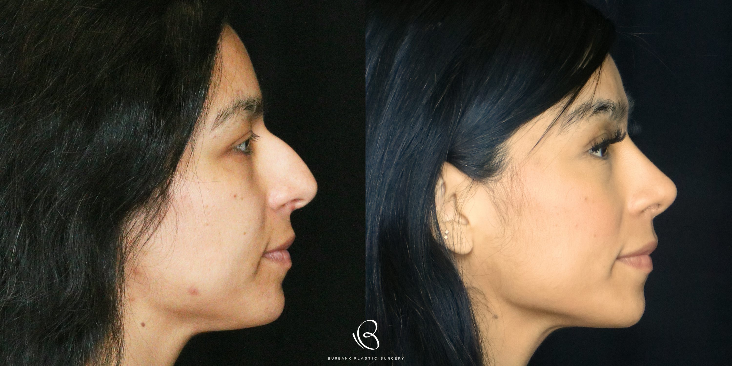 Women Before and After Rhinoplasty Right Side View