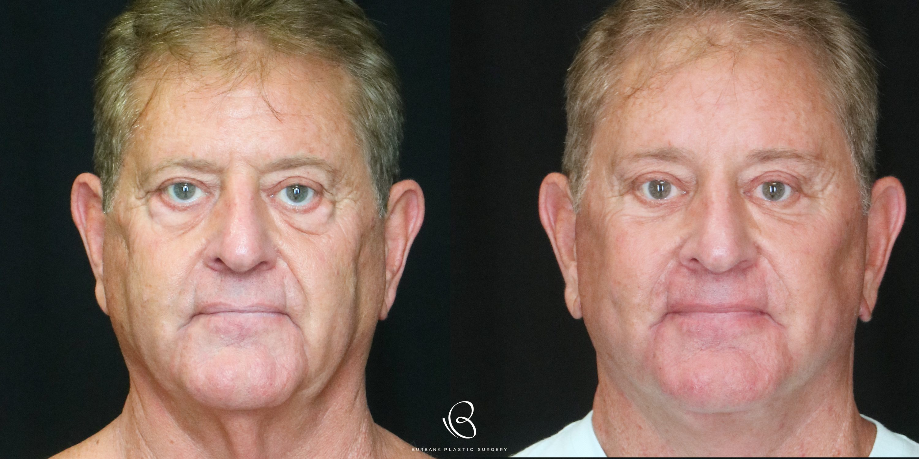 Man Before and After Facelift, Necklift, Brow lift, Upper & Lower Blepharoplasty Front View
