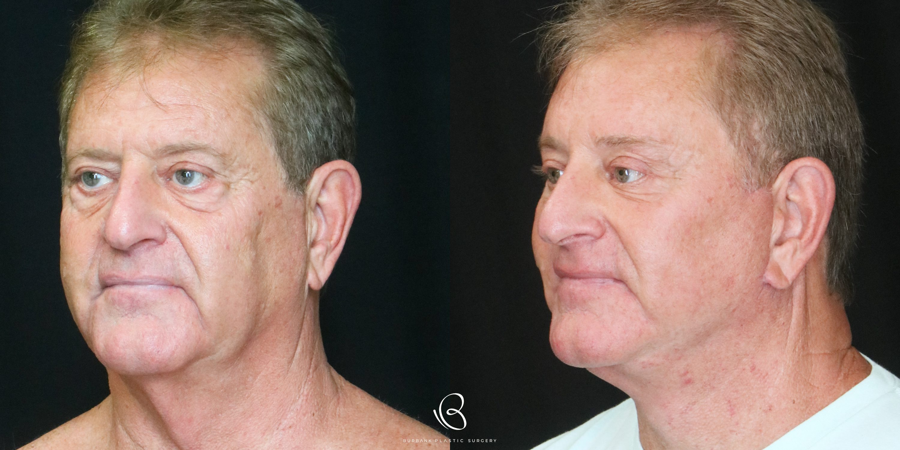 Man Before and After Facelift, Necklift, Brow lift, Upper & Lower Blepharoplasty Left Side 45 degree  View