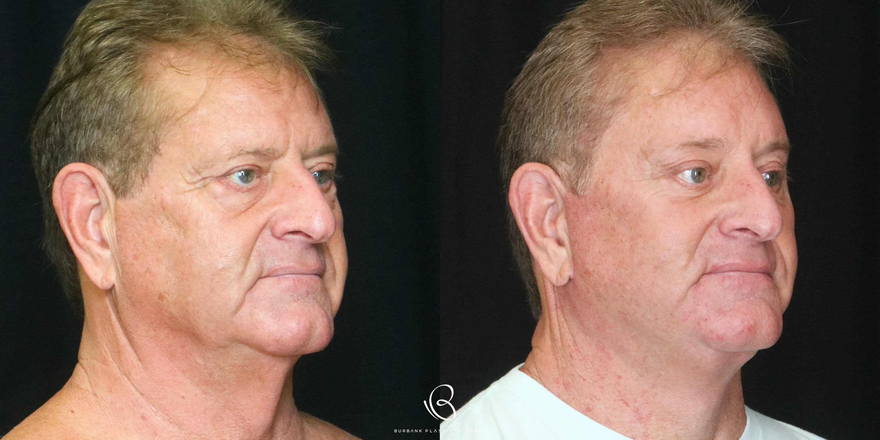 Man Before and After Facelift, Necklift, Brow lift, Upper & Lower Blepharoplasty Right Side 45 degree View