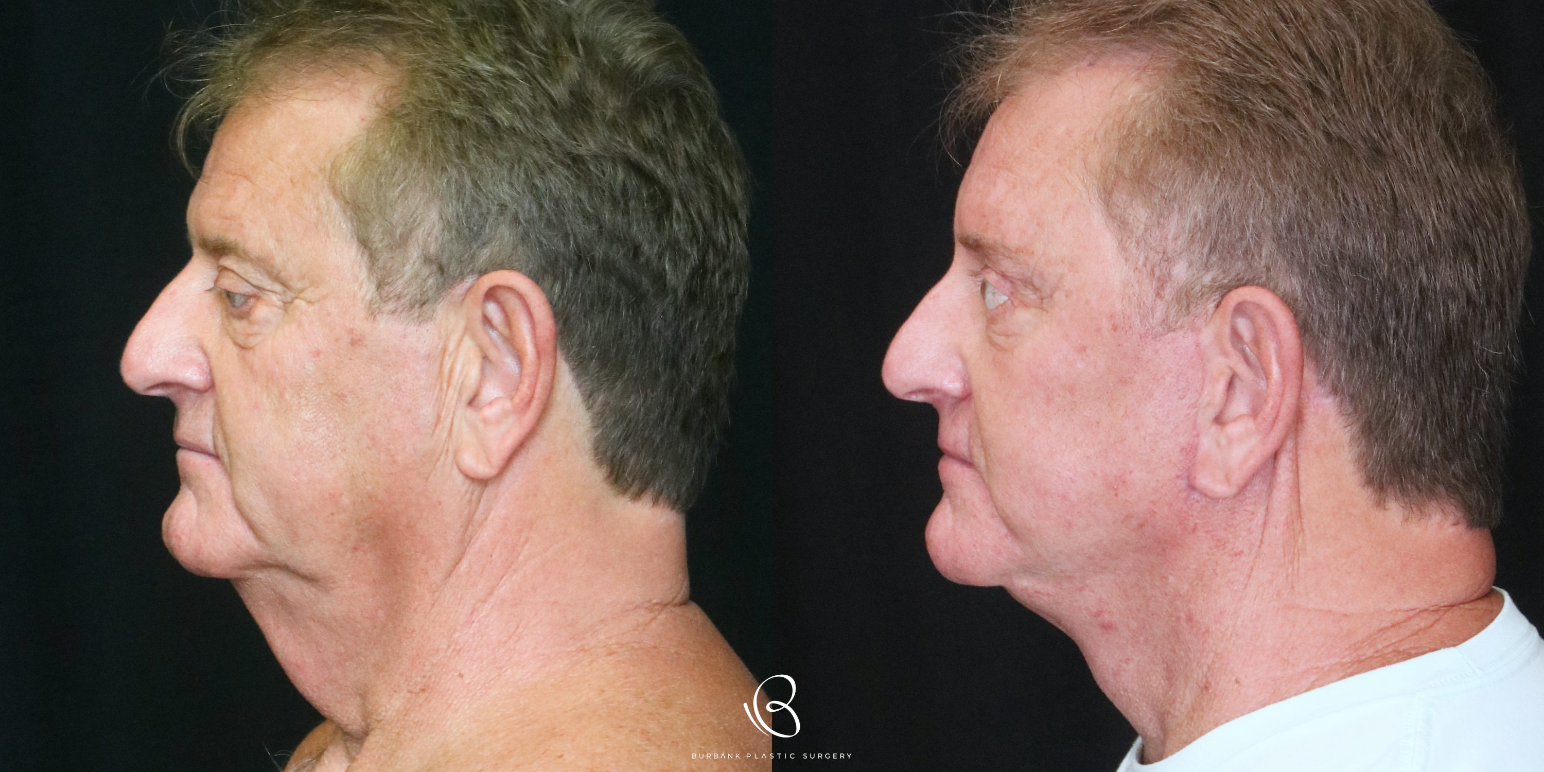 Man Before and After Facelift, Necklift, Brow lift, Upper & Lower Blepharoplasty Left Side View