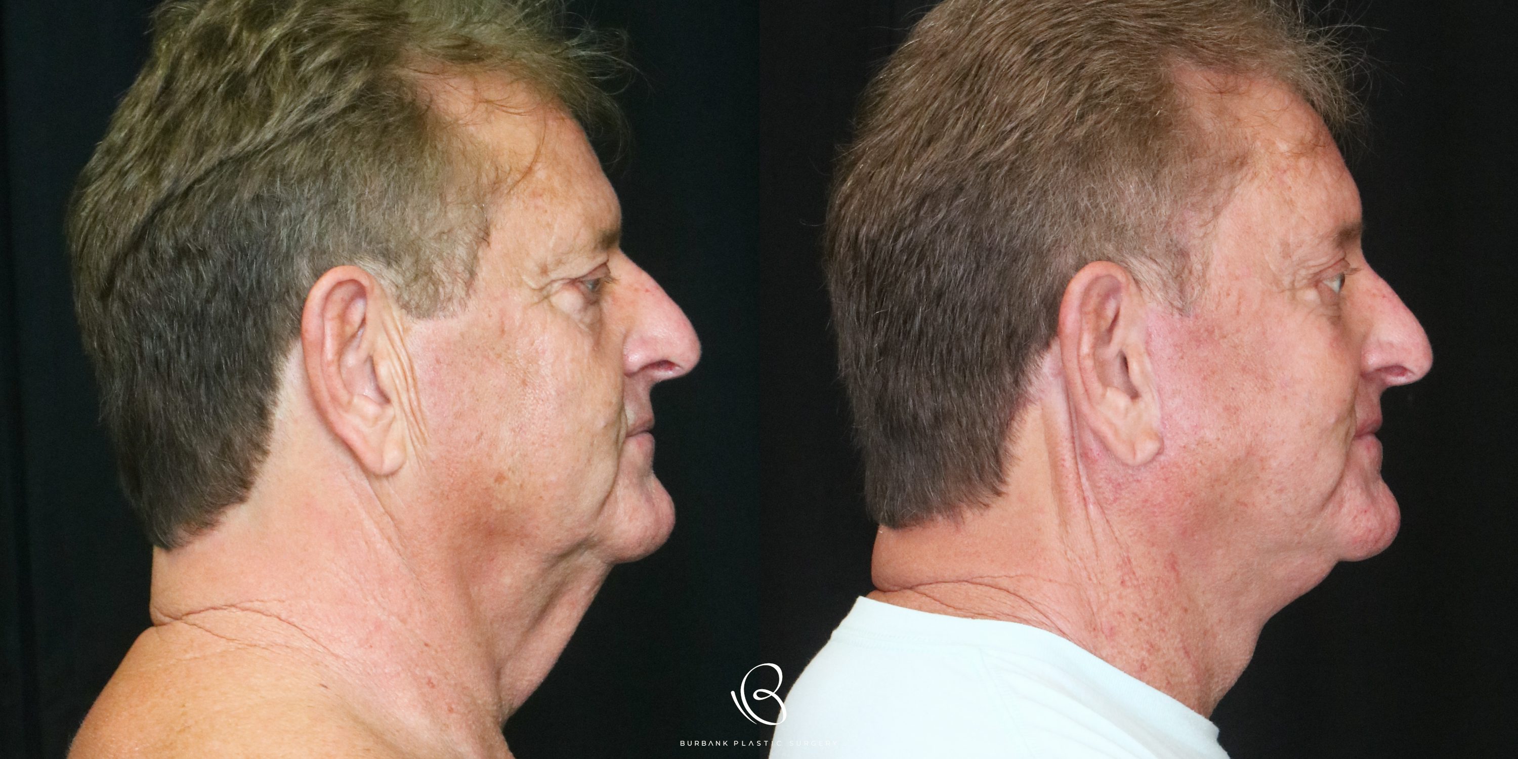 Man Before and After Facelift, Necklift, Brow lift, Upper & Lower Blepharoplasty Right Side View