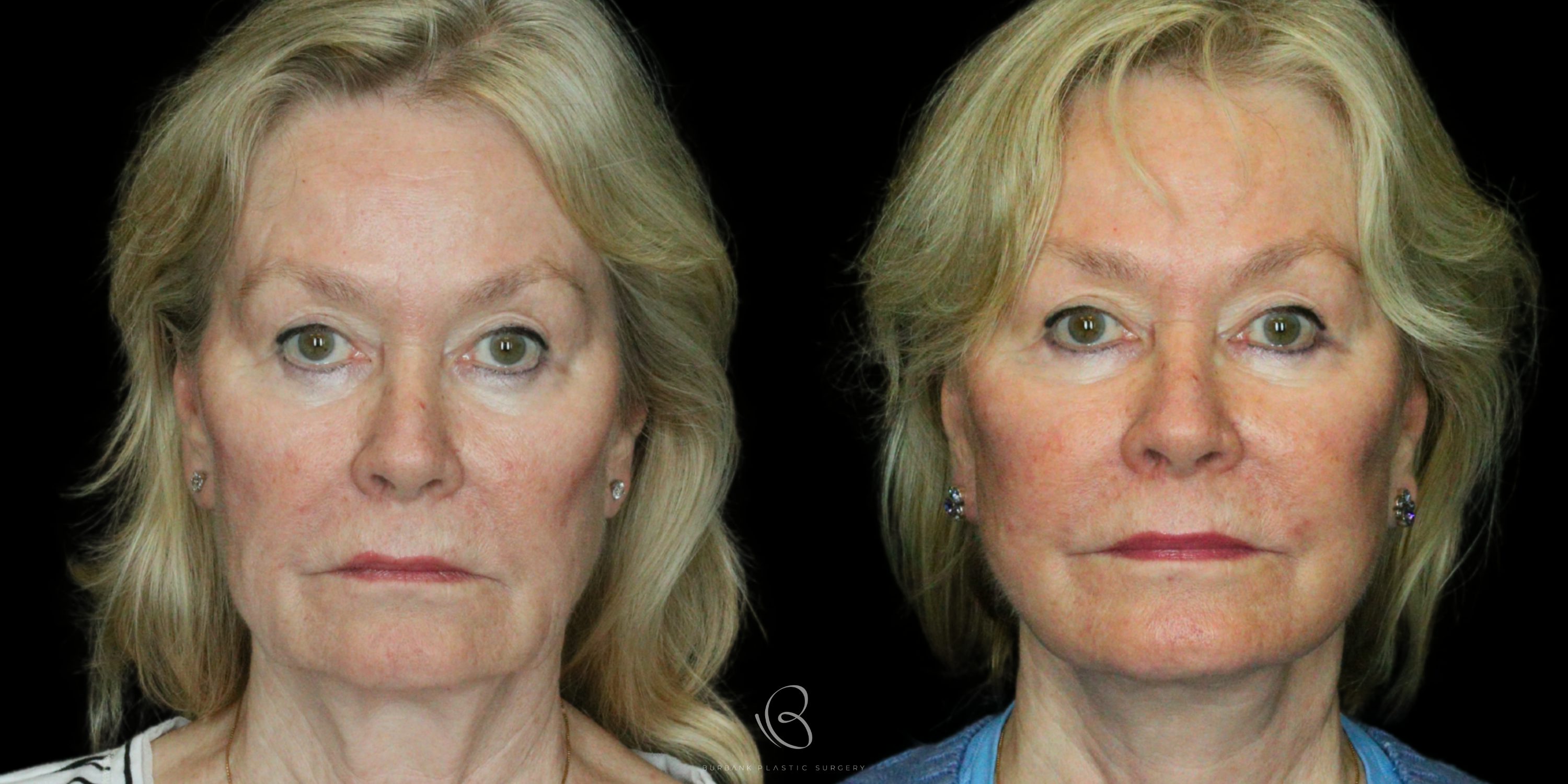 Woman Before and After Neck Lift  Front View