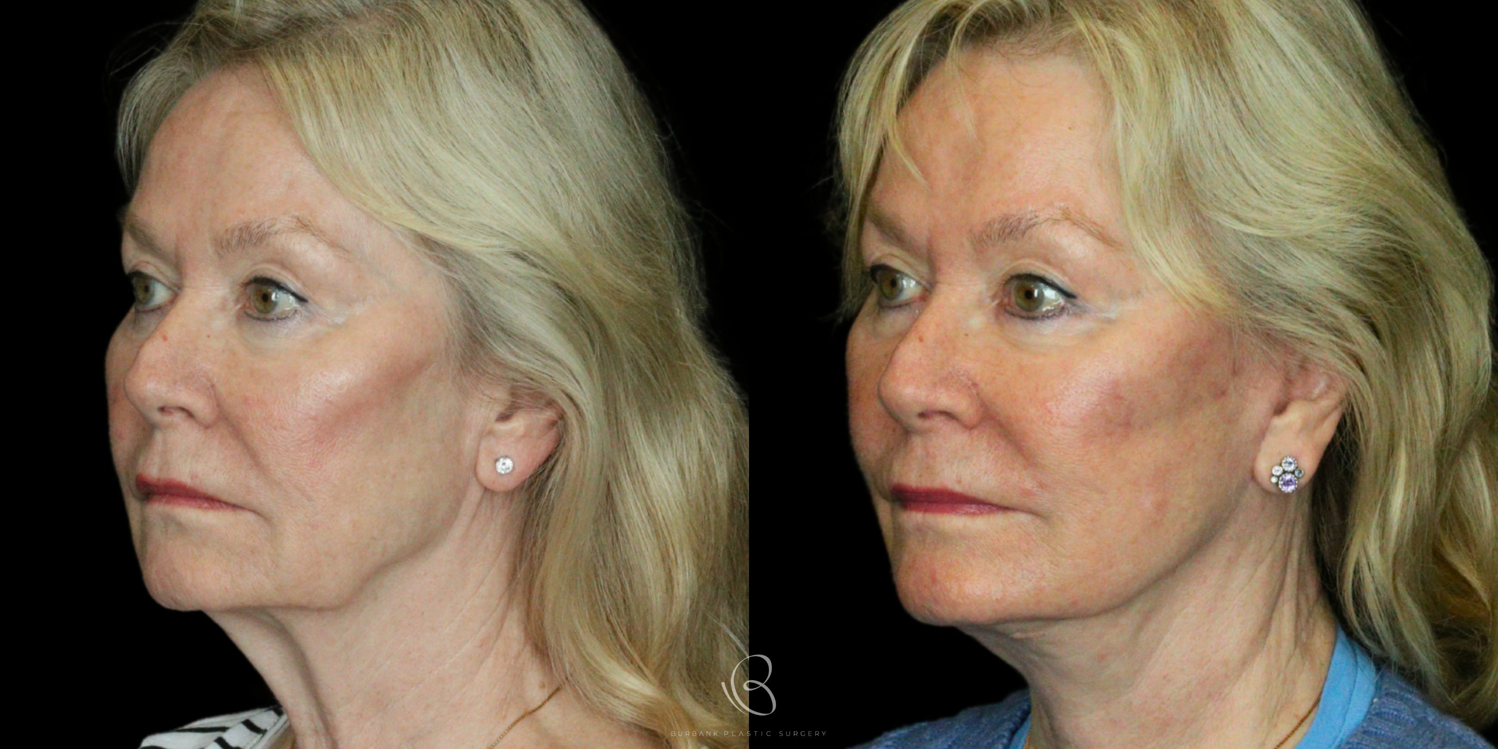 Woman Before and After Neck Lift Left Side 45 degree View