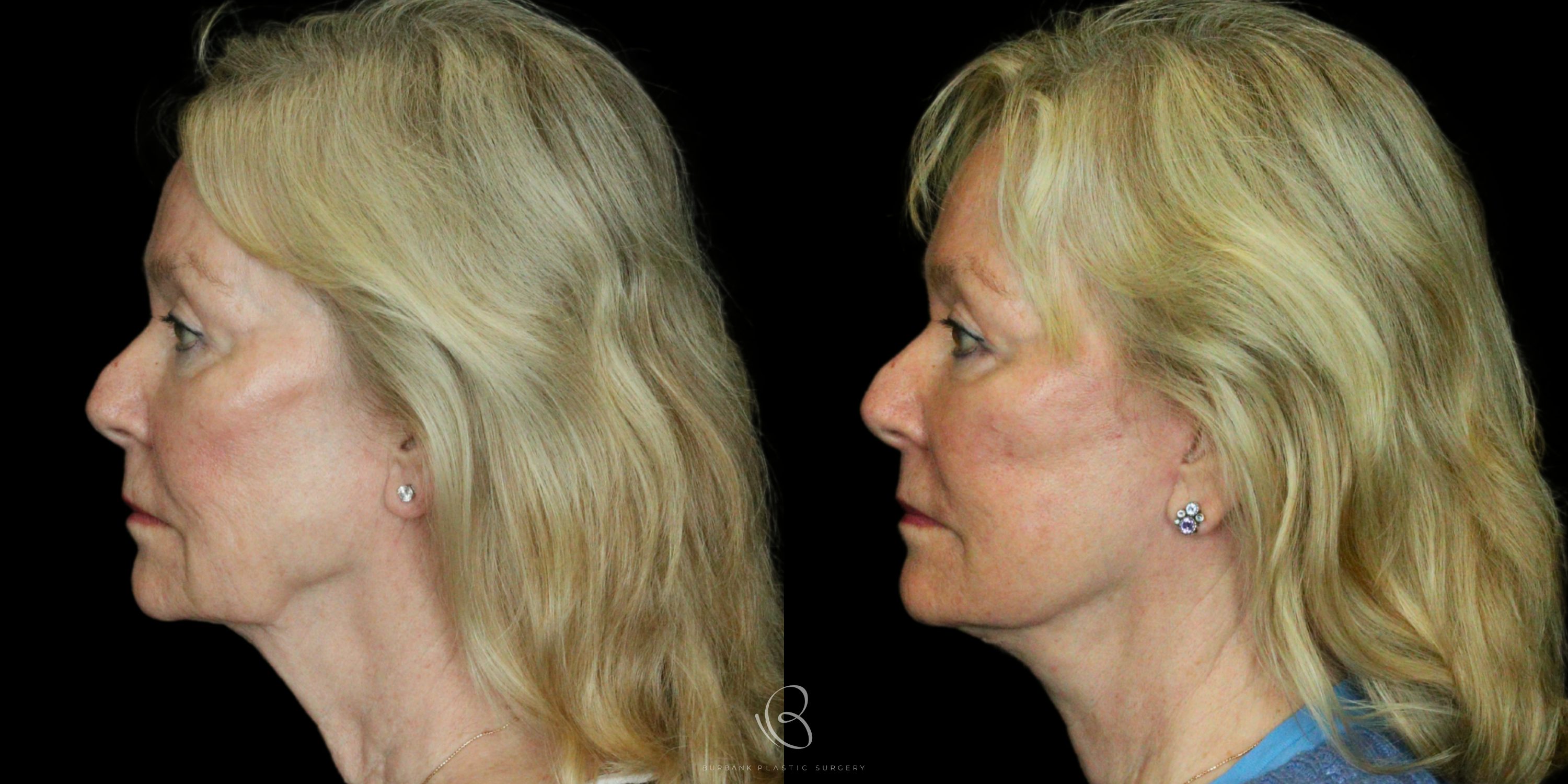 Woman Before and After Neck Lift Left Side View