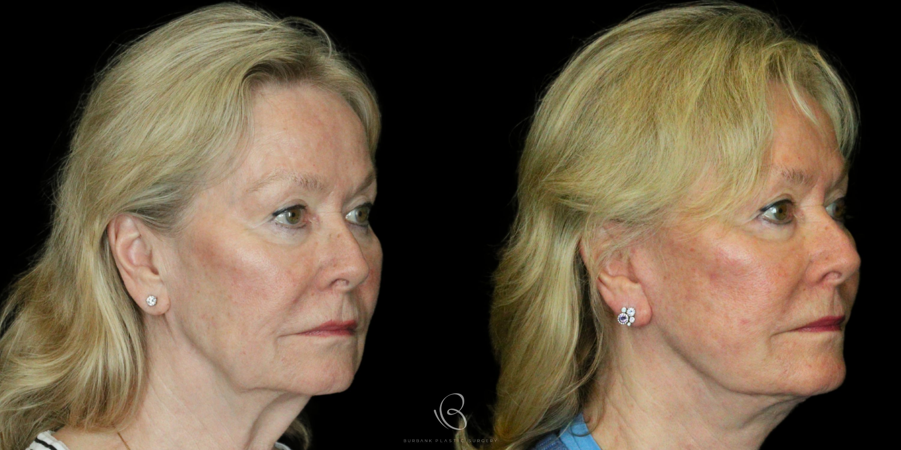 Woman Before and After Neck Right Side 45 degree View