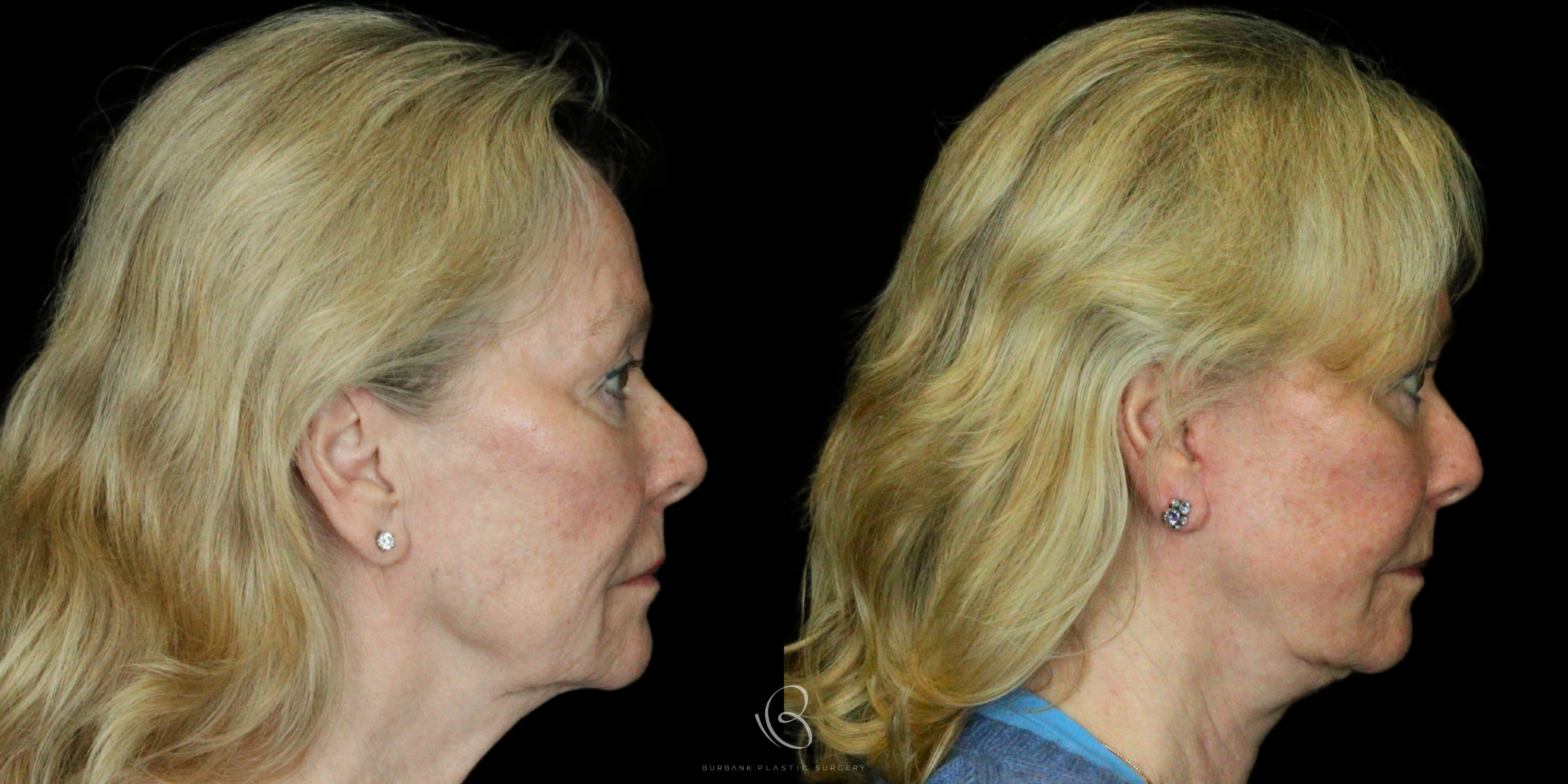 Woman Before and After Neck Right Side View
