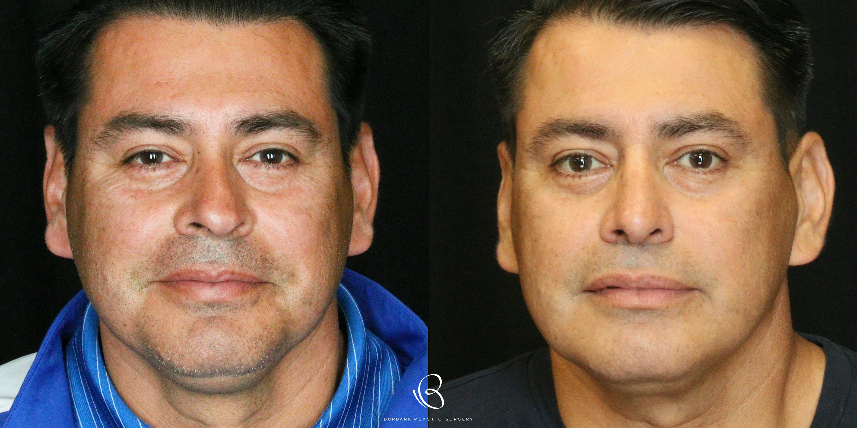 Male Before and After Rhinoplasty Front View