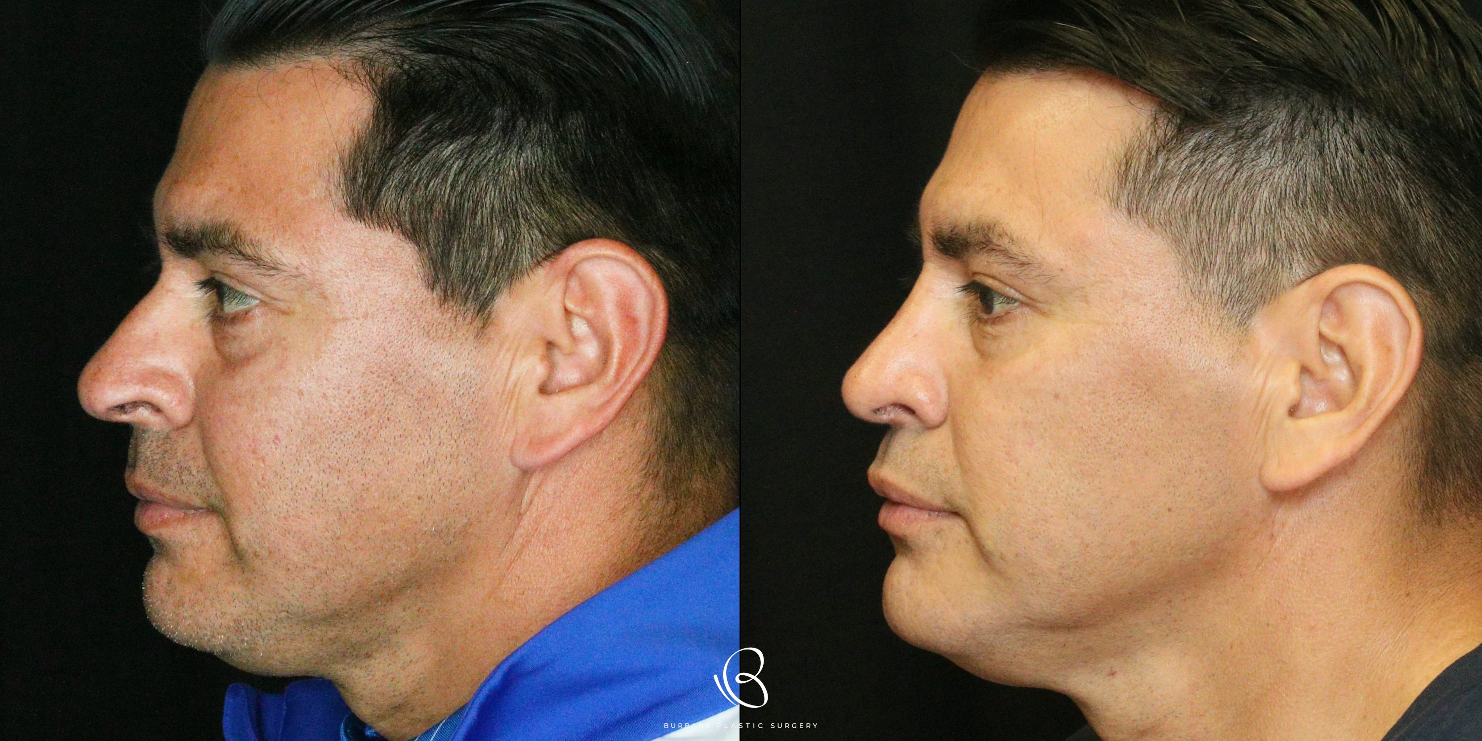 Male Before and After Rhinoplasty Left Side View