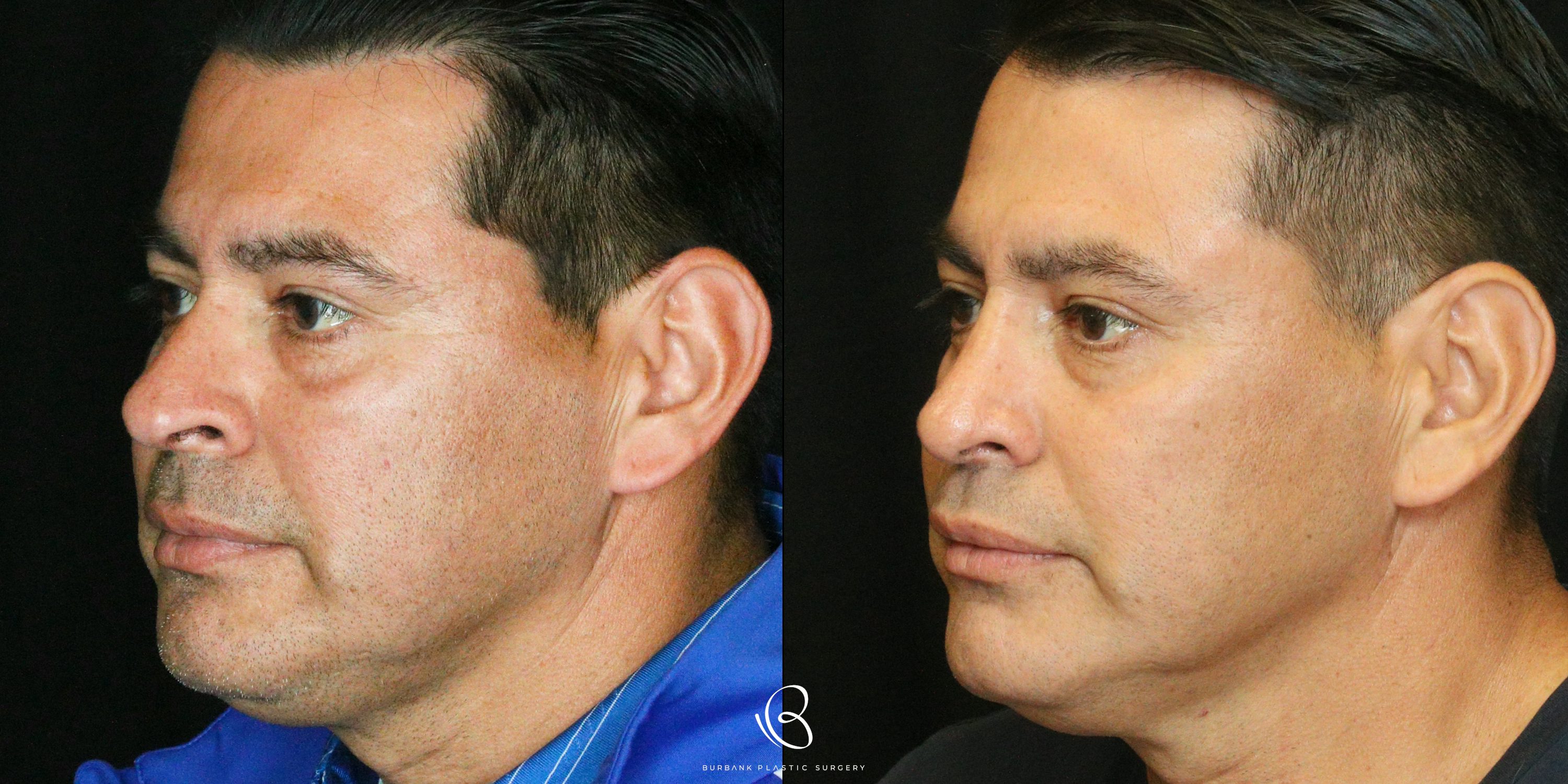 Male Before and After Rhinoplasty Left Side 45 degree View