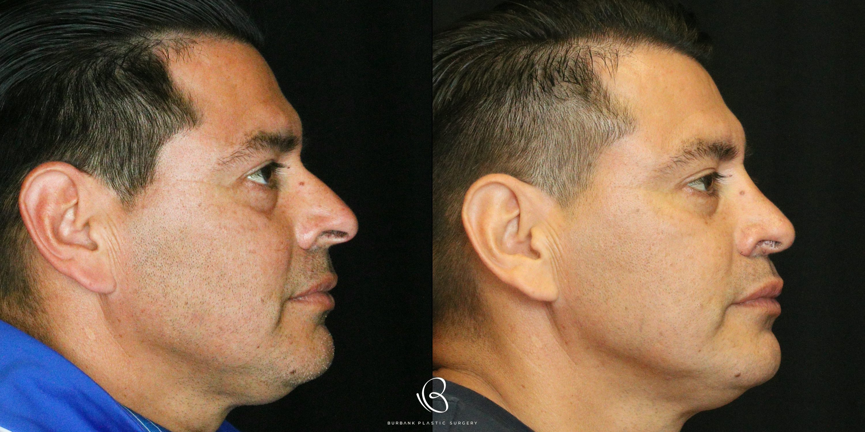 Male Before and After Rhinoplasty Right Side  View