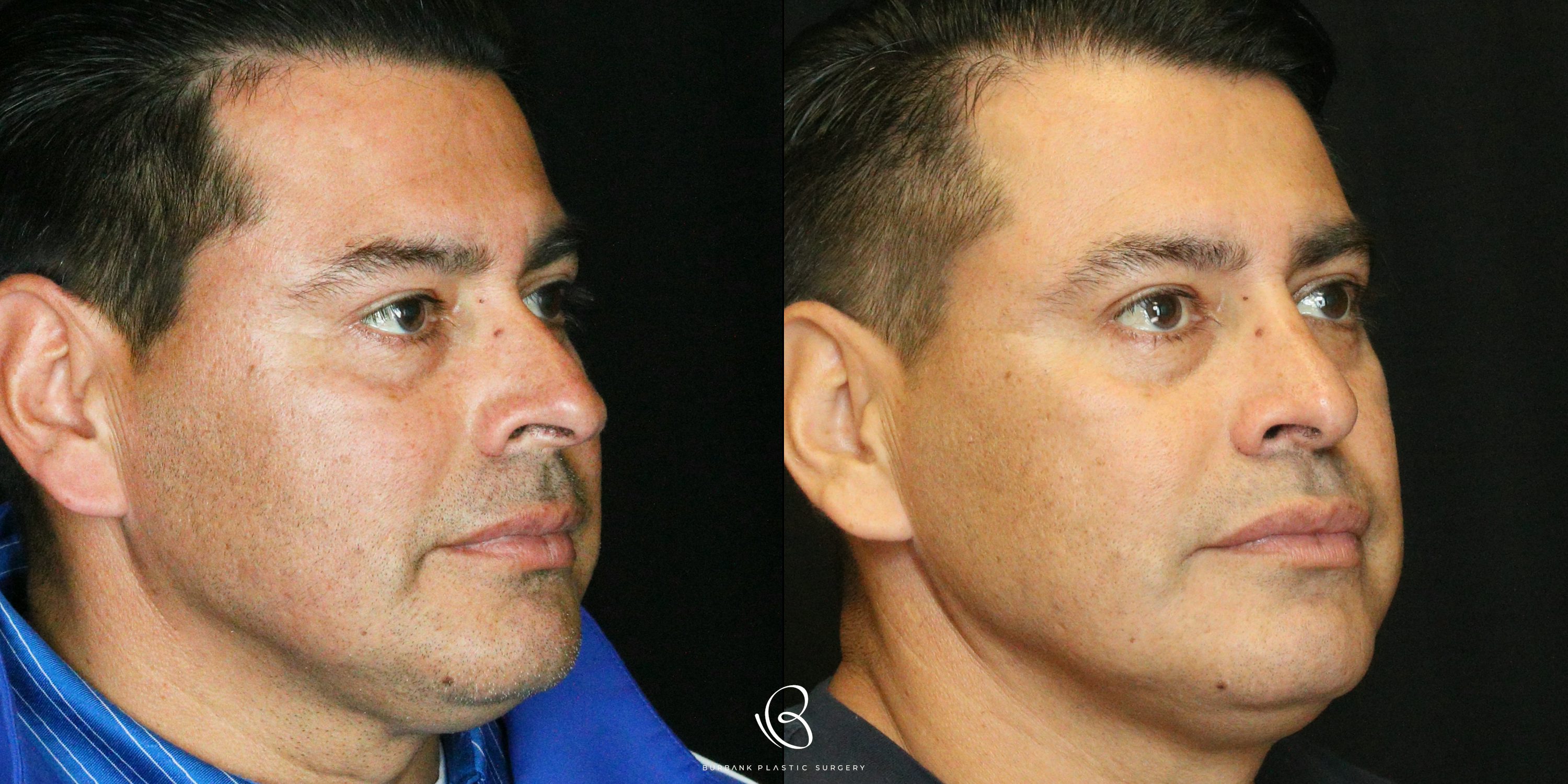 Male Before and After Rhinoplasty Right Side 45 degree  View