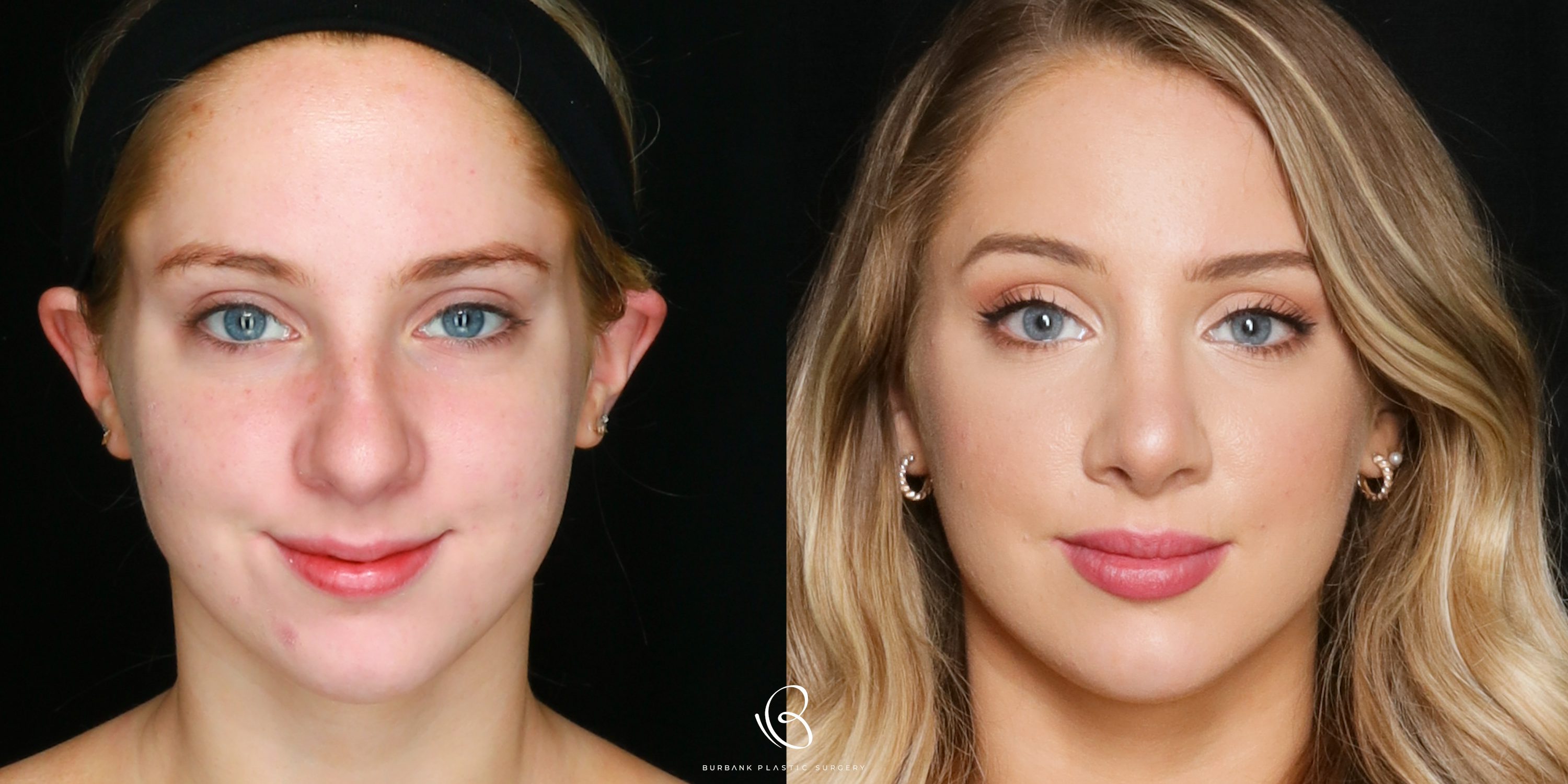 Woman Before and After Rhinoplasty Front View