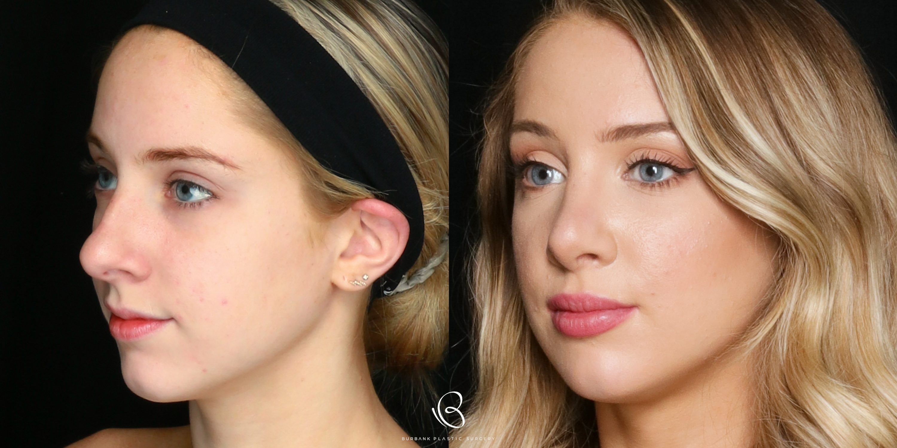 Woman Before and After Rhinoplasty Left side View