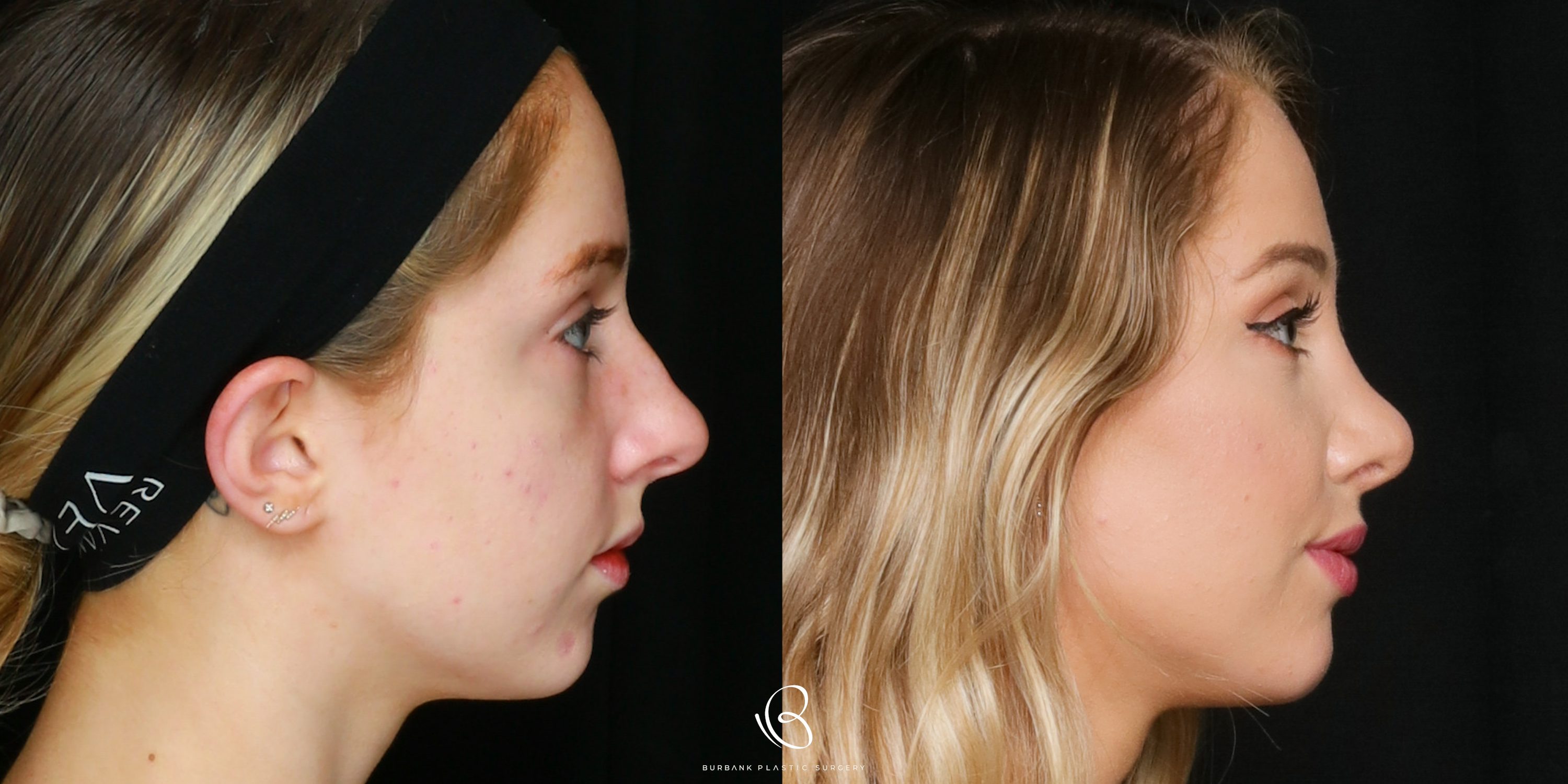 Woman Before and After Rhinoplasty Right Profile View