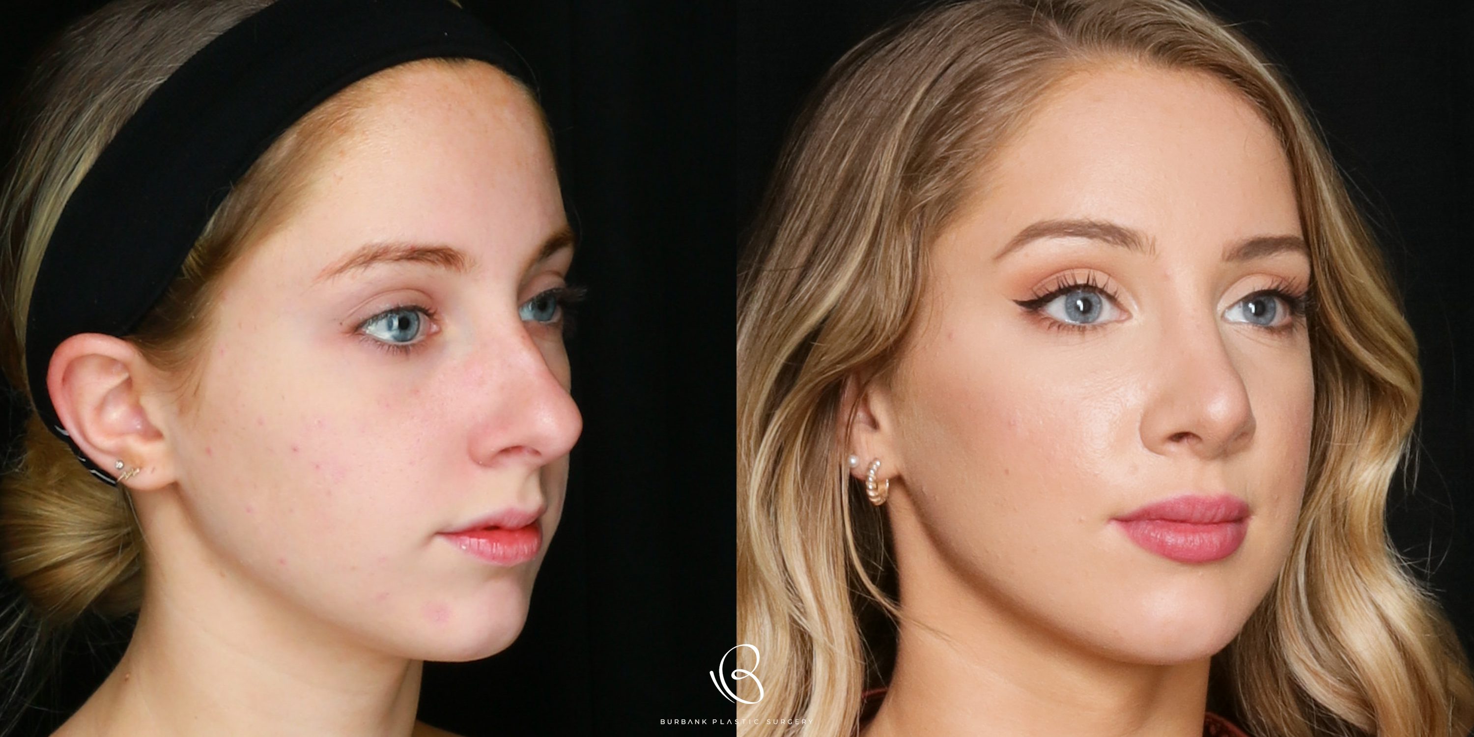 Woman Before and After RhinoplastyRight SIde View