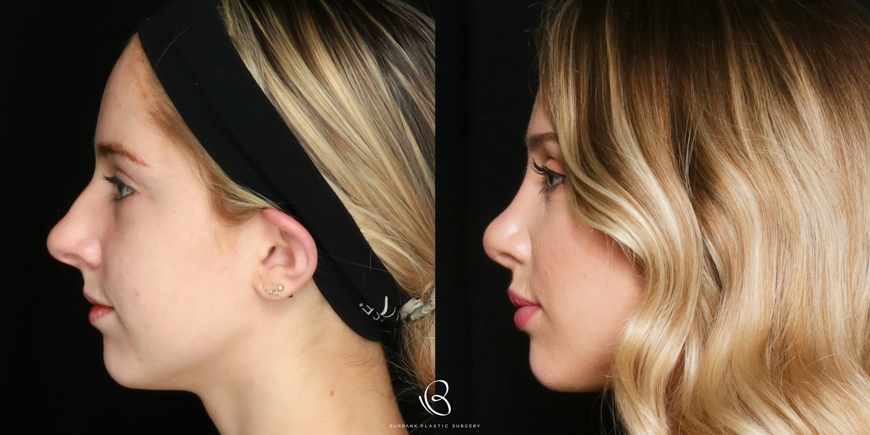 Woman Before and After Rhinoplasty Left Profile View