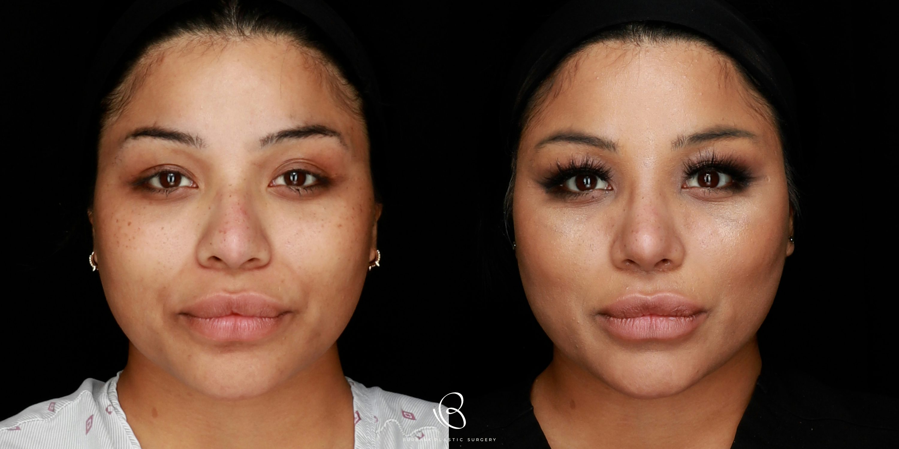 Woman Before and After Rhinoplasty and Brow Lift Front View