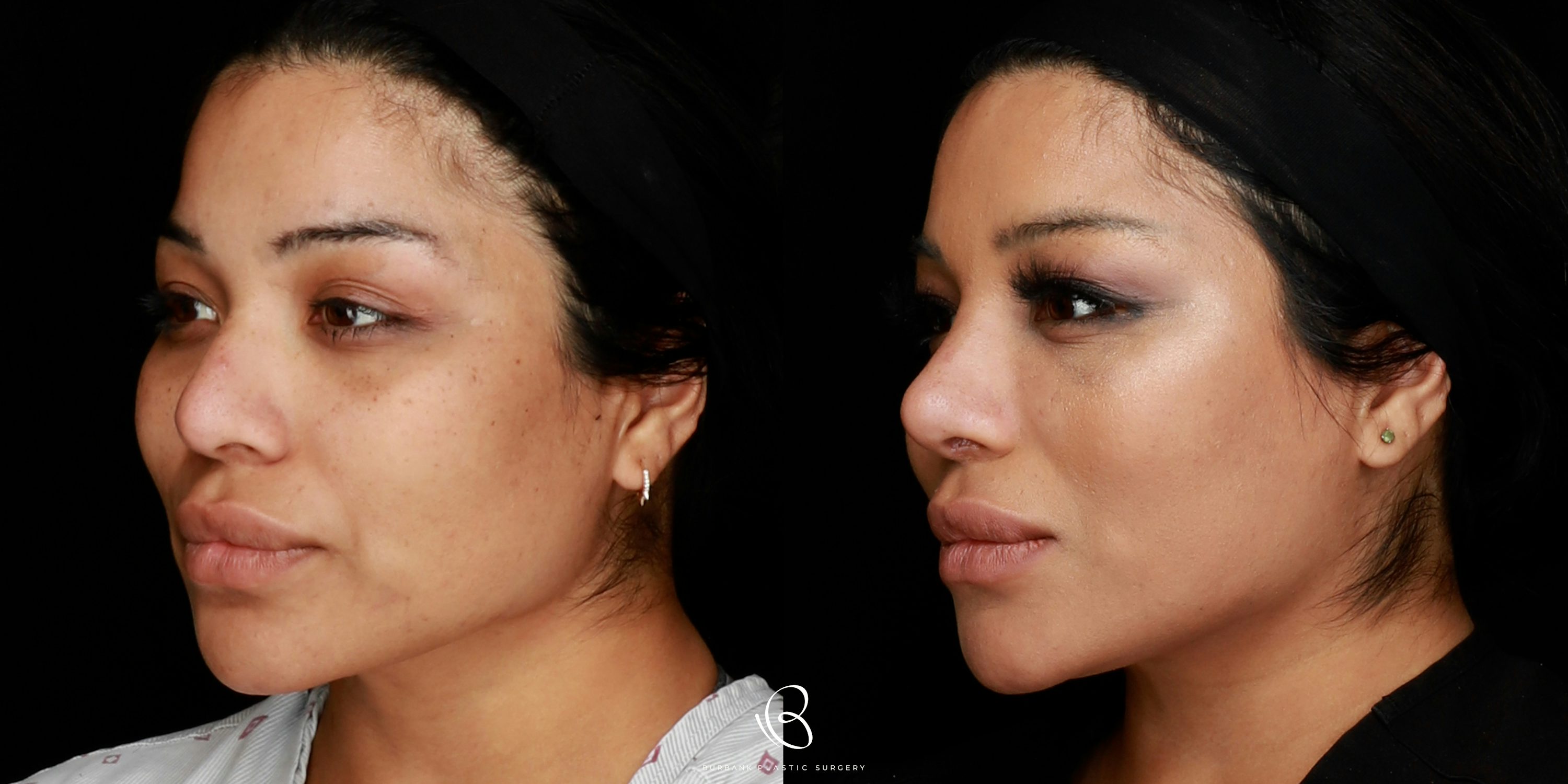 Woman Before and After Rhinoplasty and Brow Lift LEFT Side View