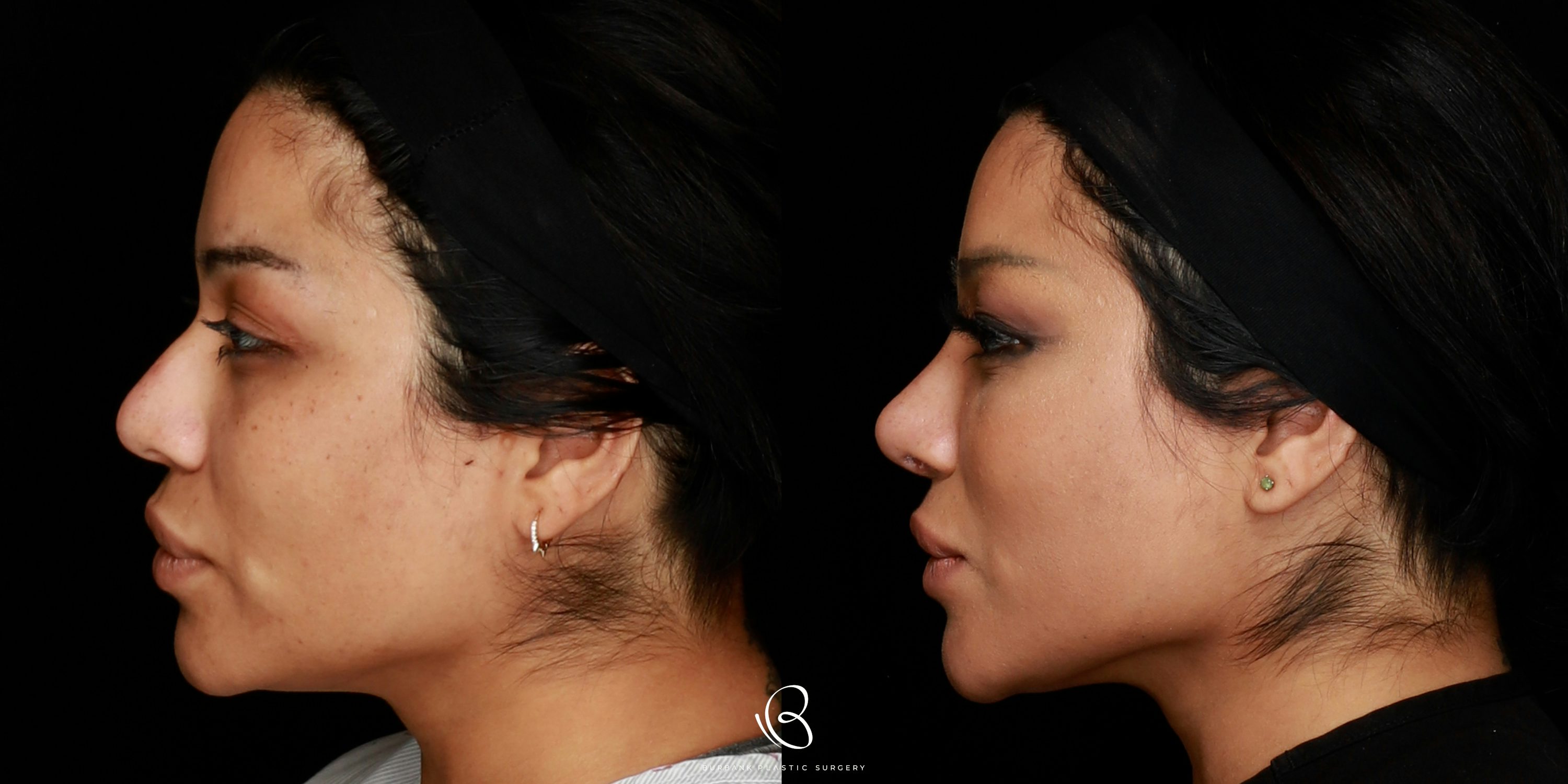 Woman Before and After Rhinoplasty and Brow Lift LEFT Profile View