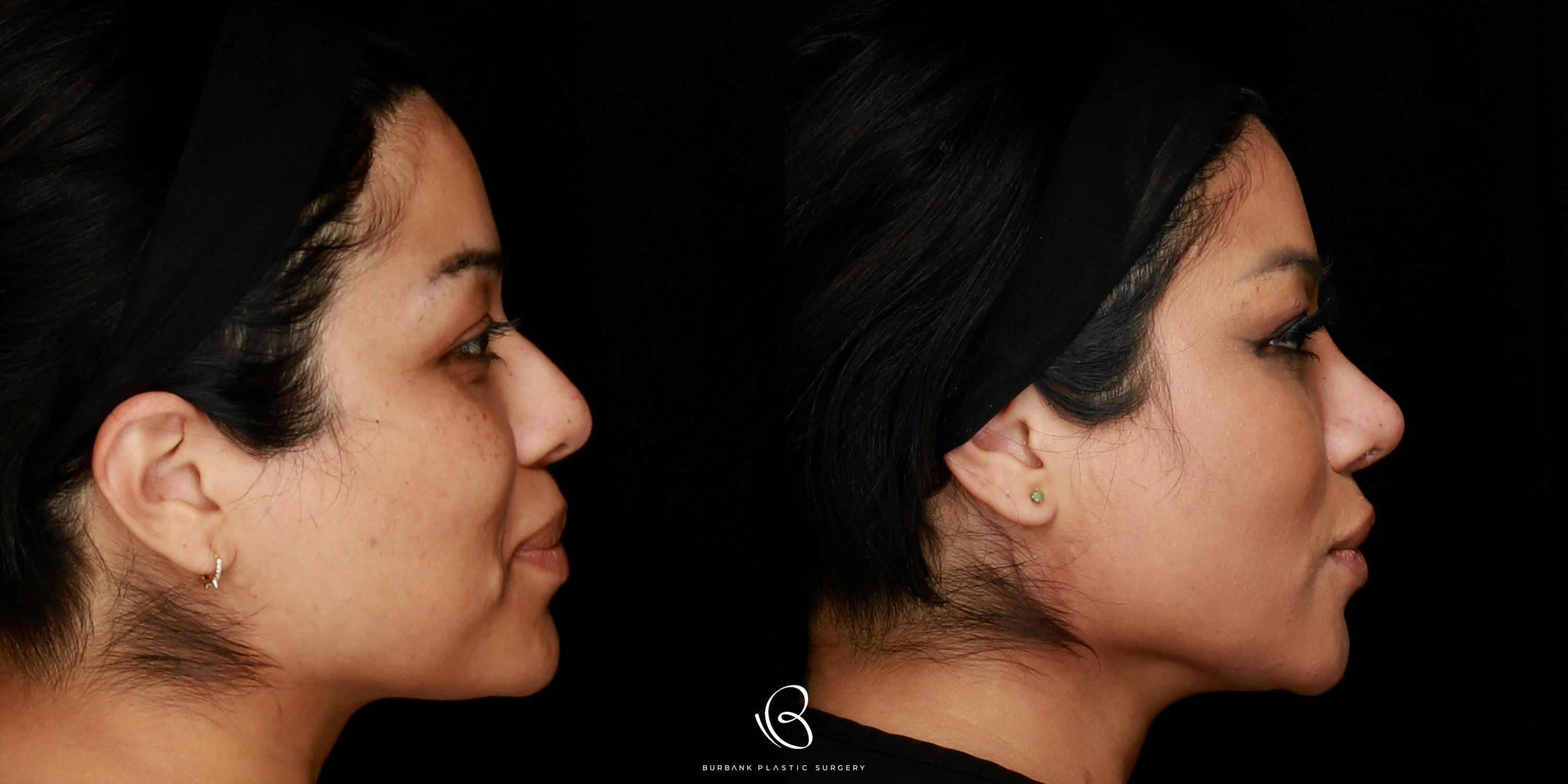 Woman Before and After Rhinoplasty and Brow Lift Right Profile View