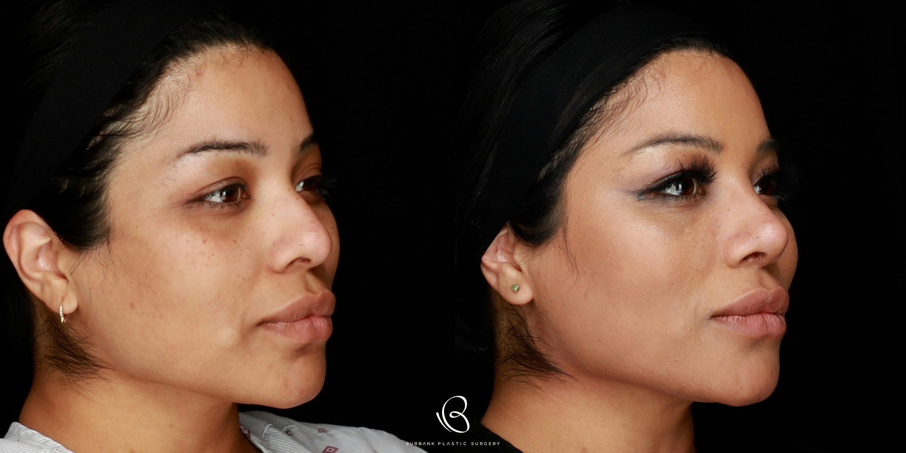 Woman Before and After Rhinoplasty and Brow Lift  Right Side View