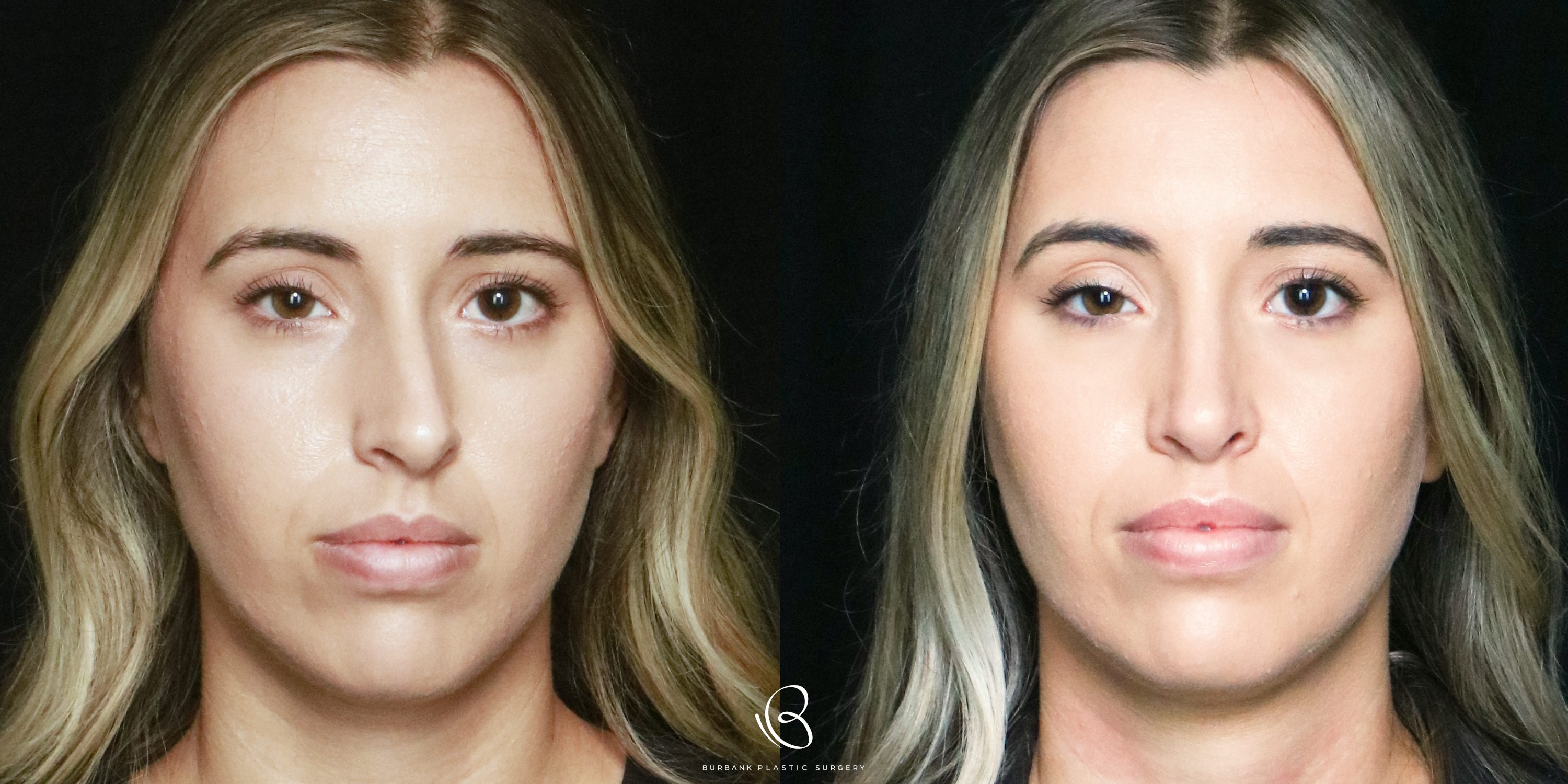 Woman Before and After Rhinoplasty Front View