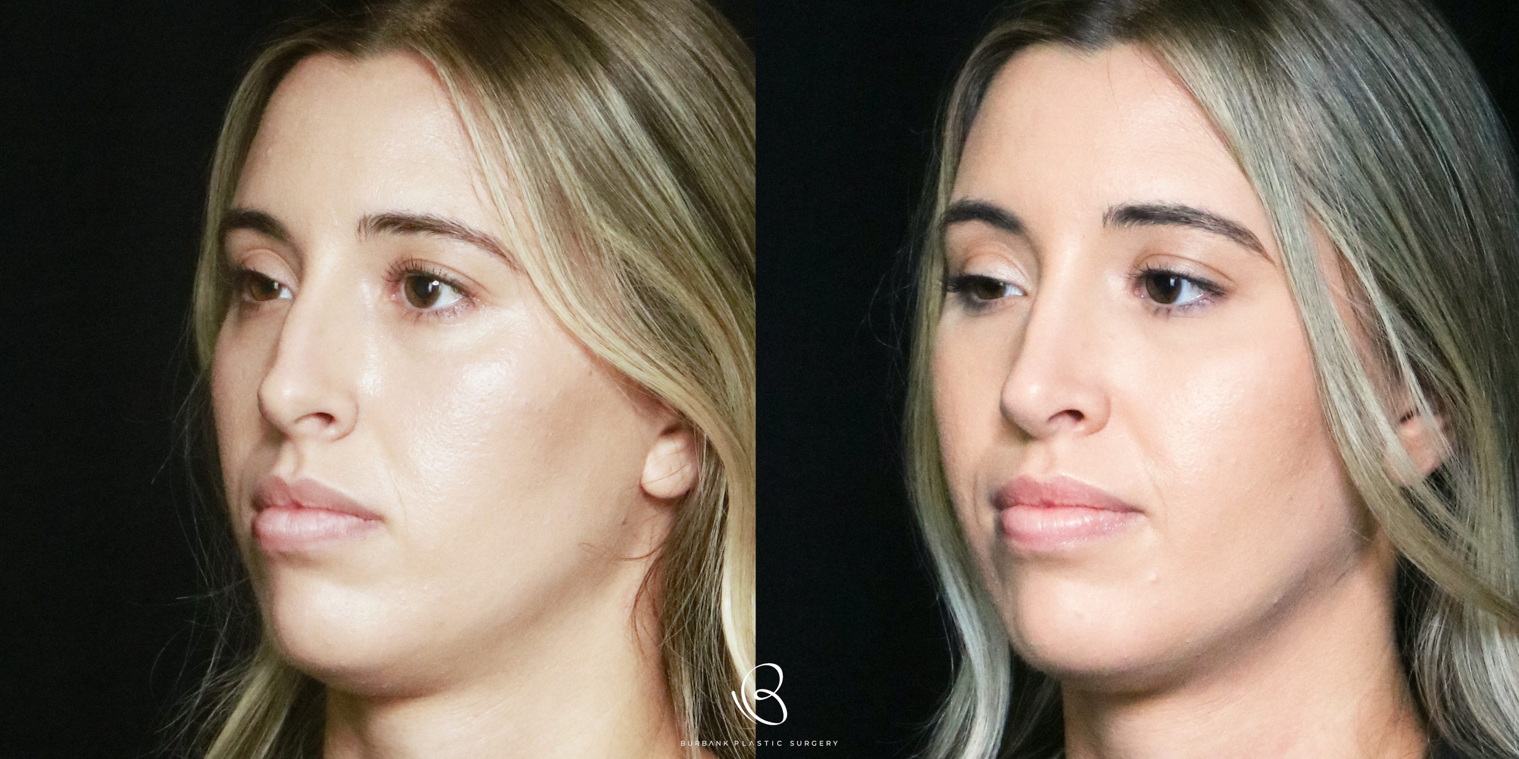 Woman Before and After Rhinoplasty Left side View