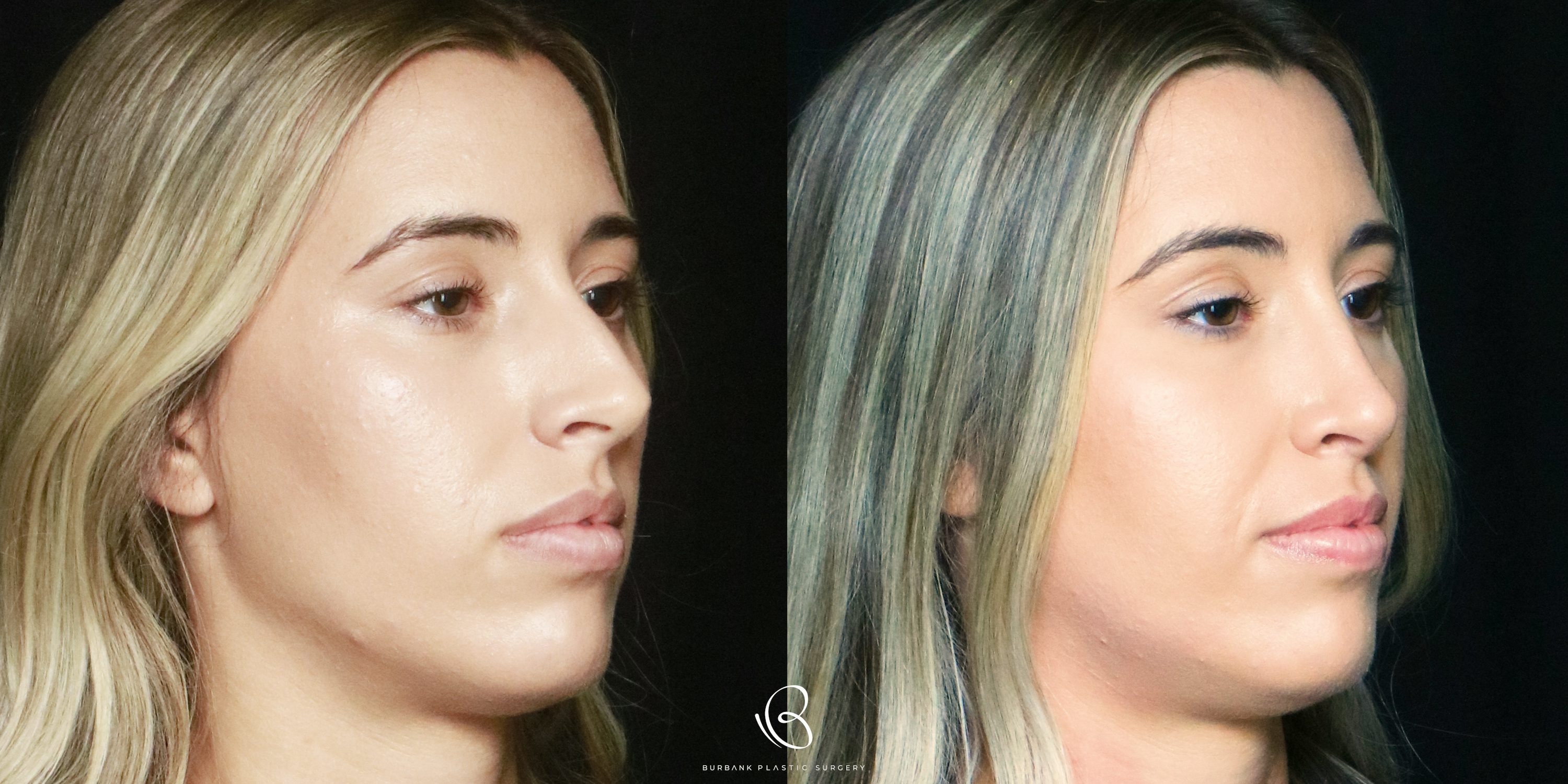 Woman Before and After Rhinoplastyright side View