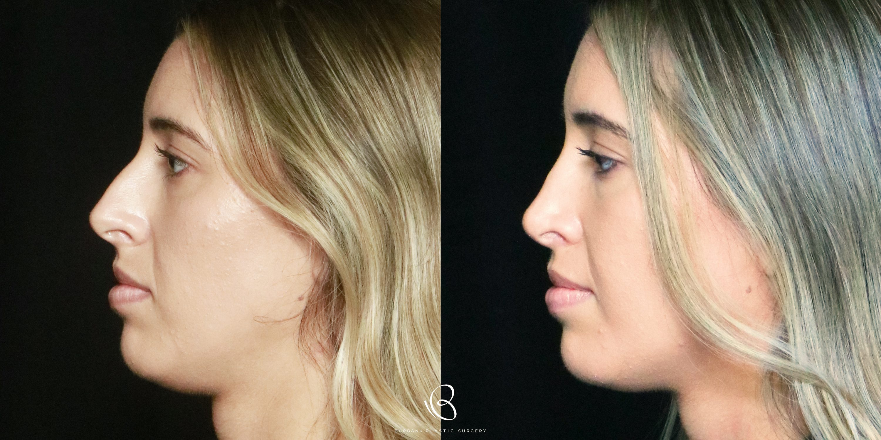 Woman Before and After Rhinoplasty Left Profile View