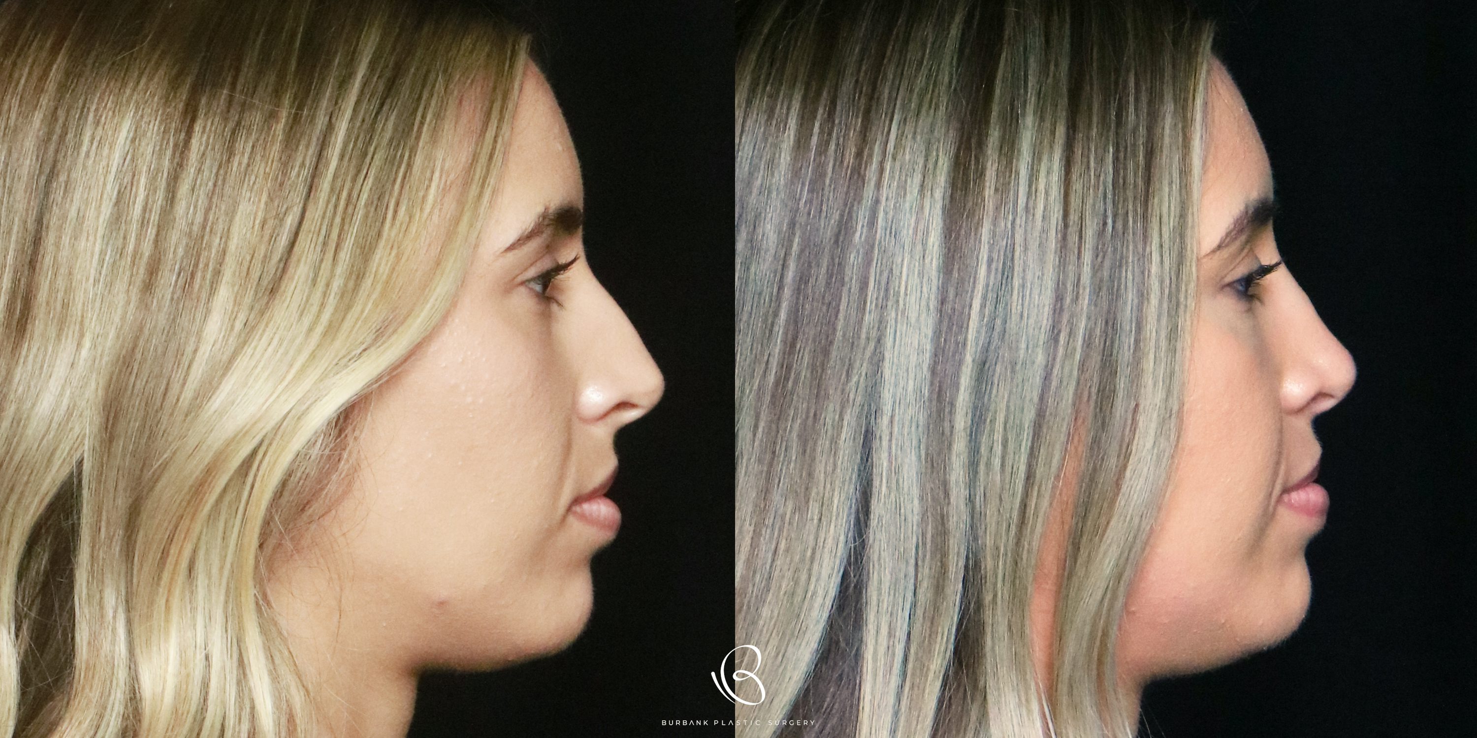Woman Before and After Rhinoplasty Right Profile View