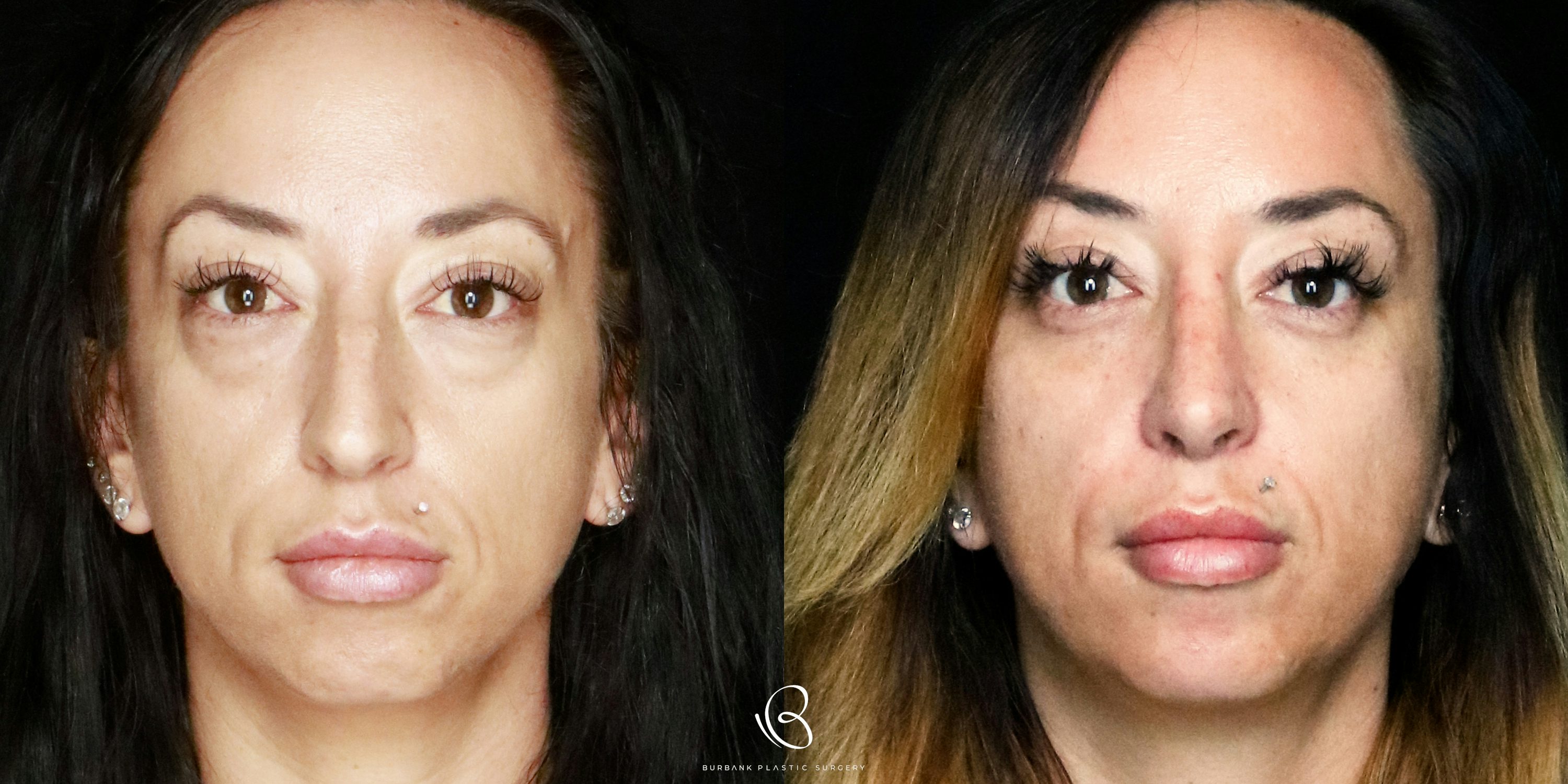 Woman Before and After Rhinoplasty and Lower Blepharoplasty Front VIew