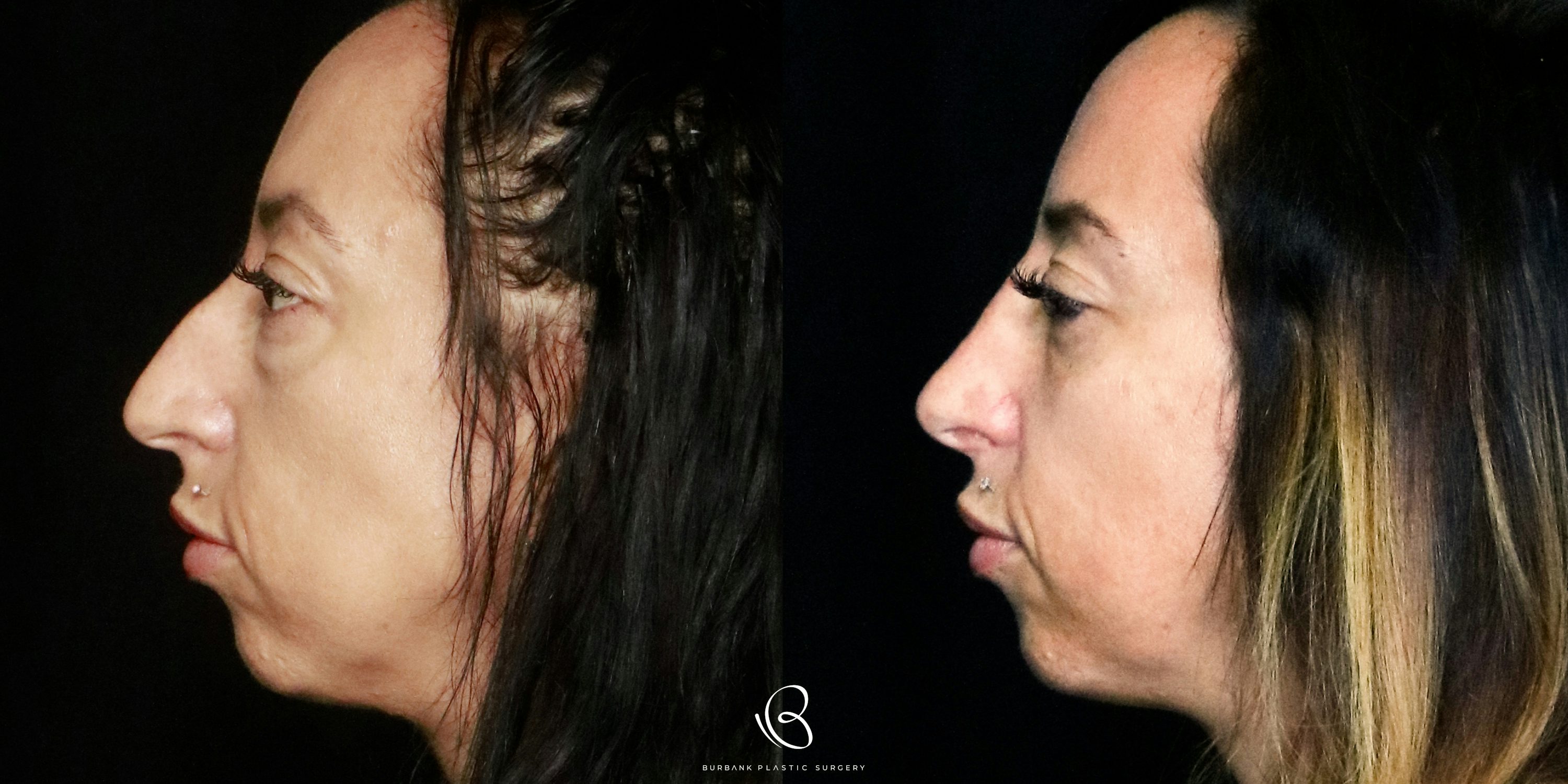Woman Before and After Rhinoplasty and Lower Blepharoplasty Left profileVIew