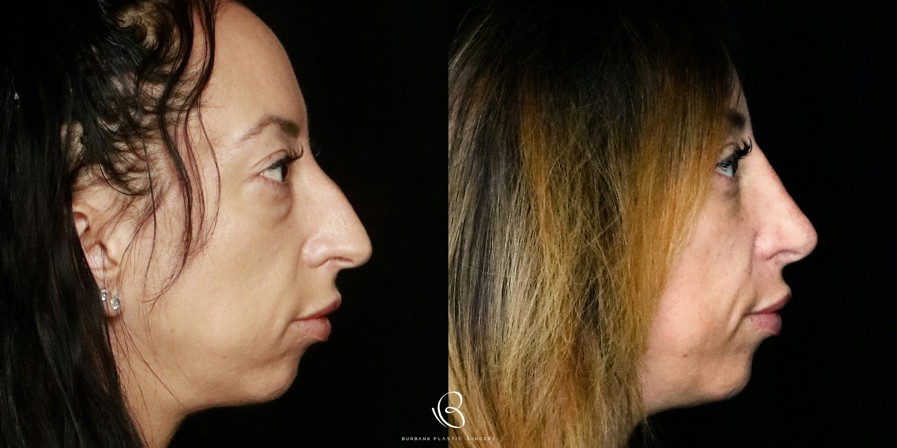 Woman Before and After Rhinoplasty and Lower Blepharoplasty right profile VIew