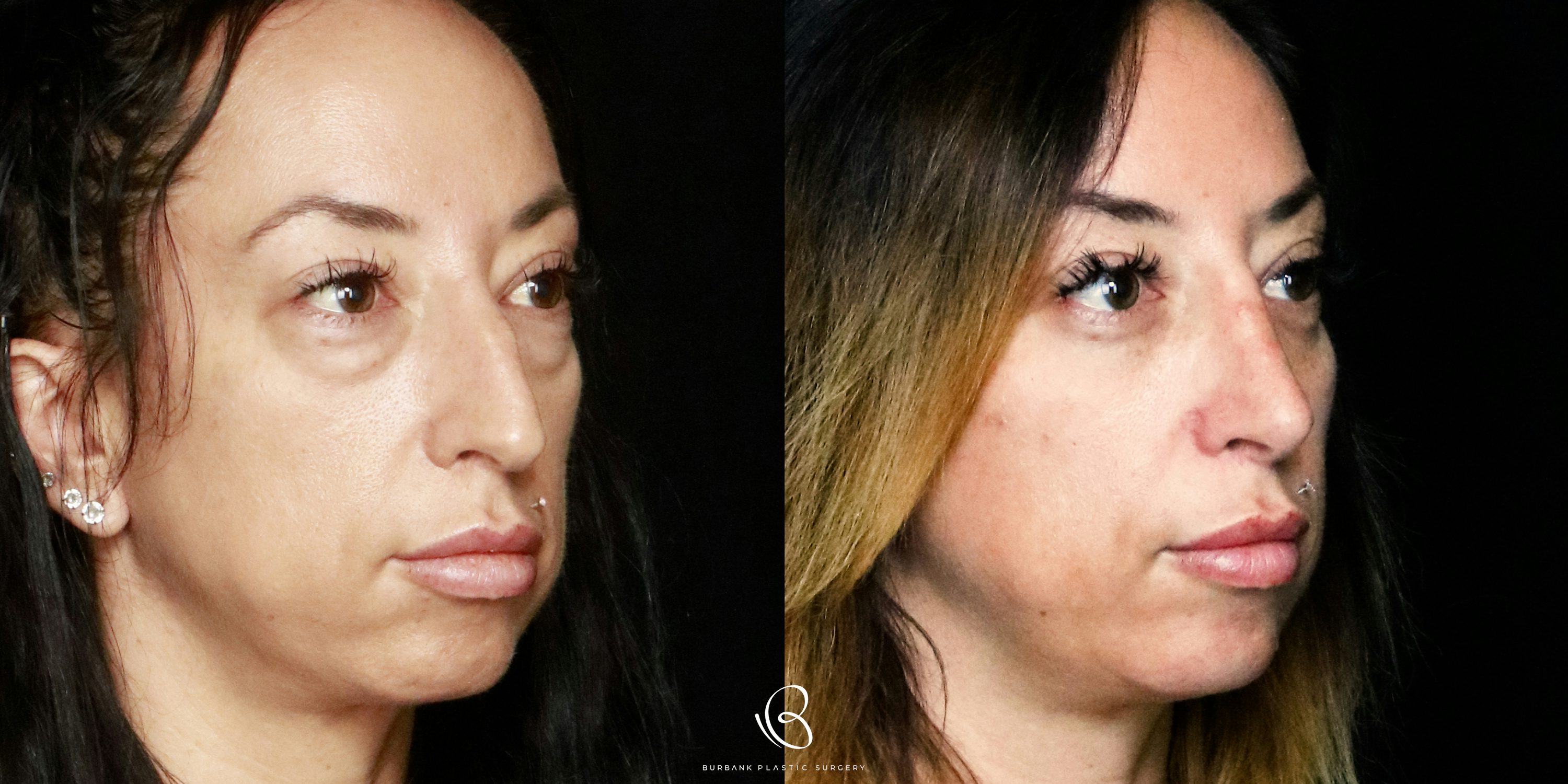 Woman Before and After Rhinoplasty and Lower Blepharoplasty right side VIew