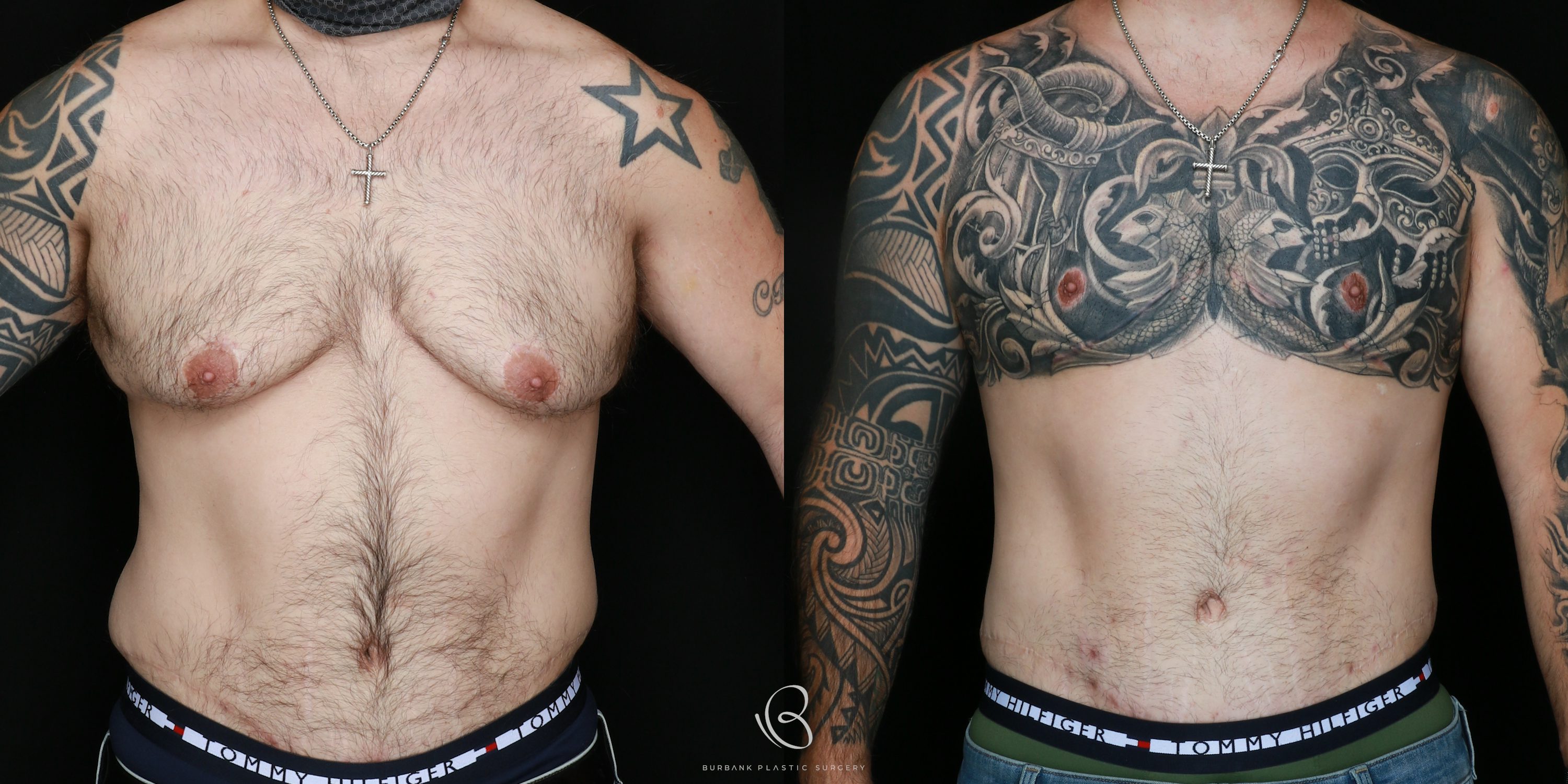 Man Before and After Gynecomastia Front View