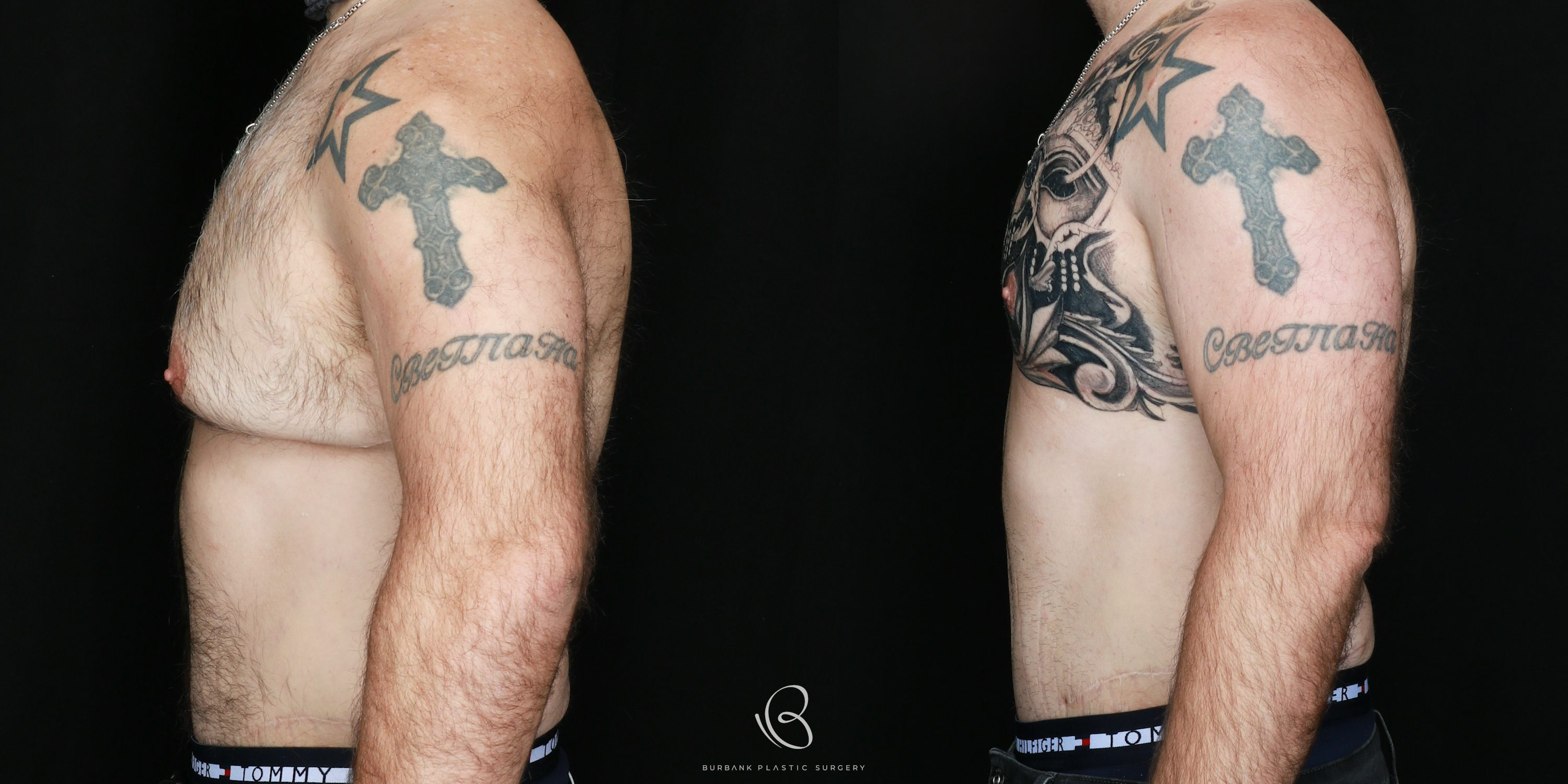 Man Before and After Gynecomastia Left Side View